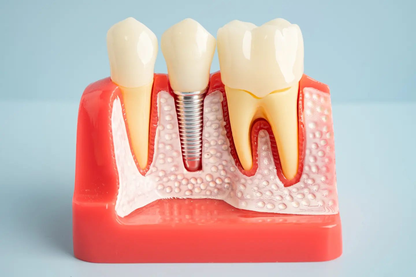 How Much Do Dental Implants Cost?