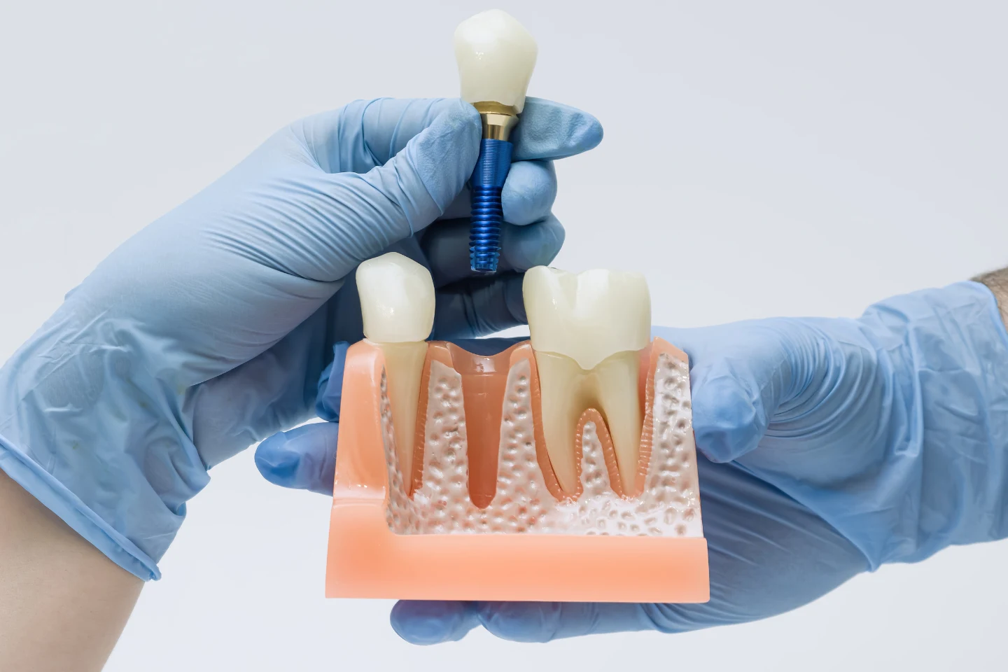 Are Dental Implants Really Worth It? A Guide for Residents in Fremont, CA