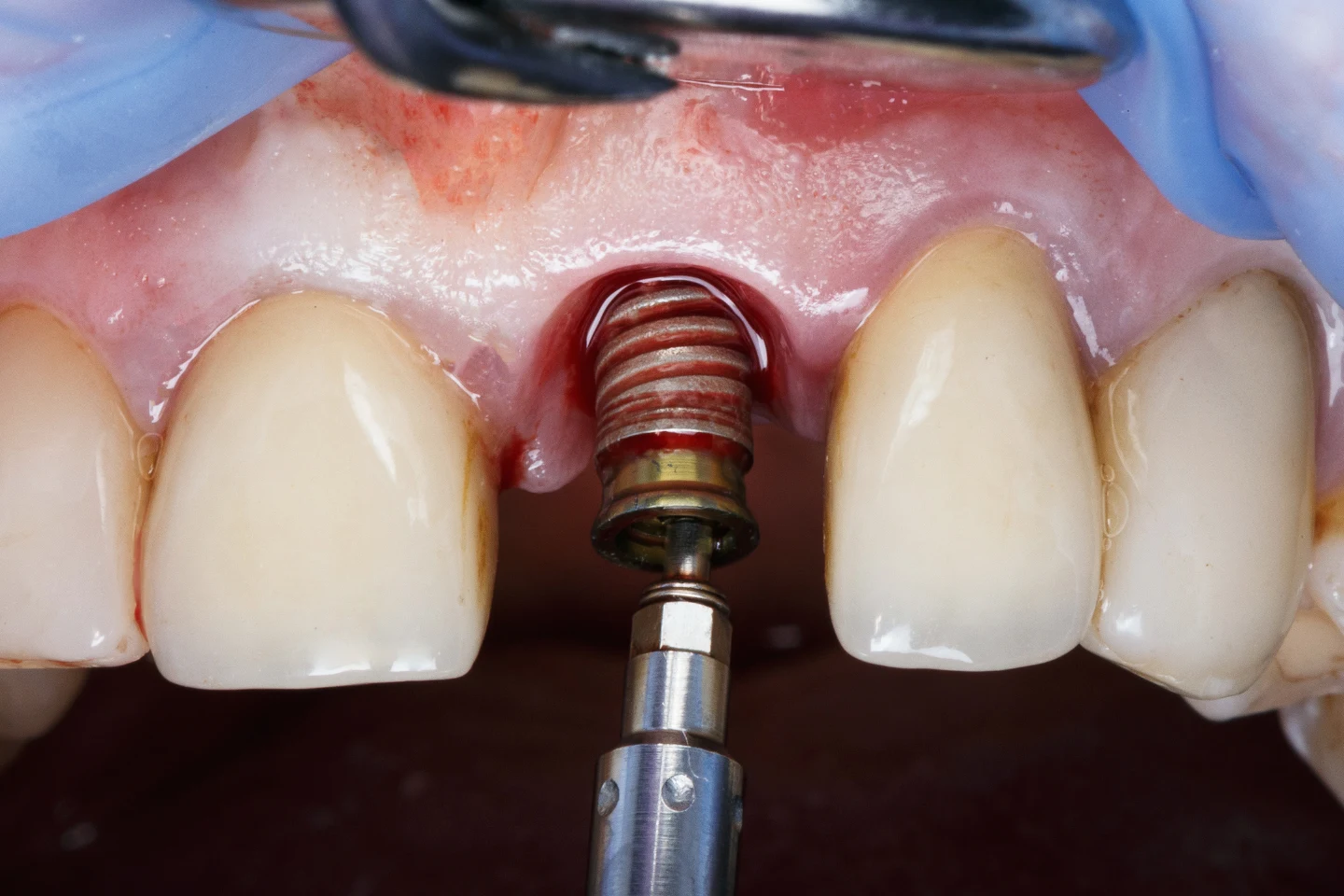 dental implant installation process