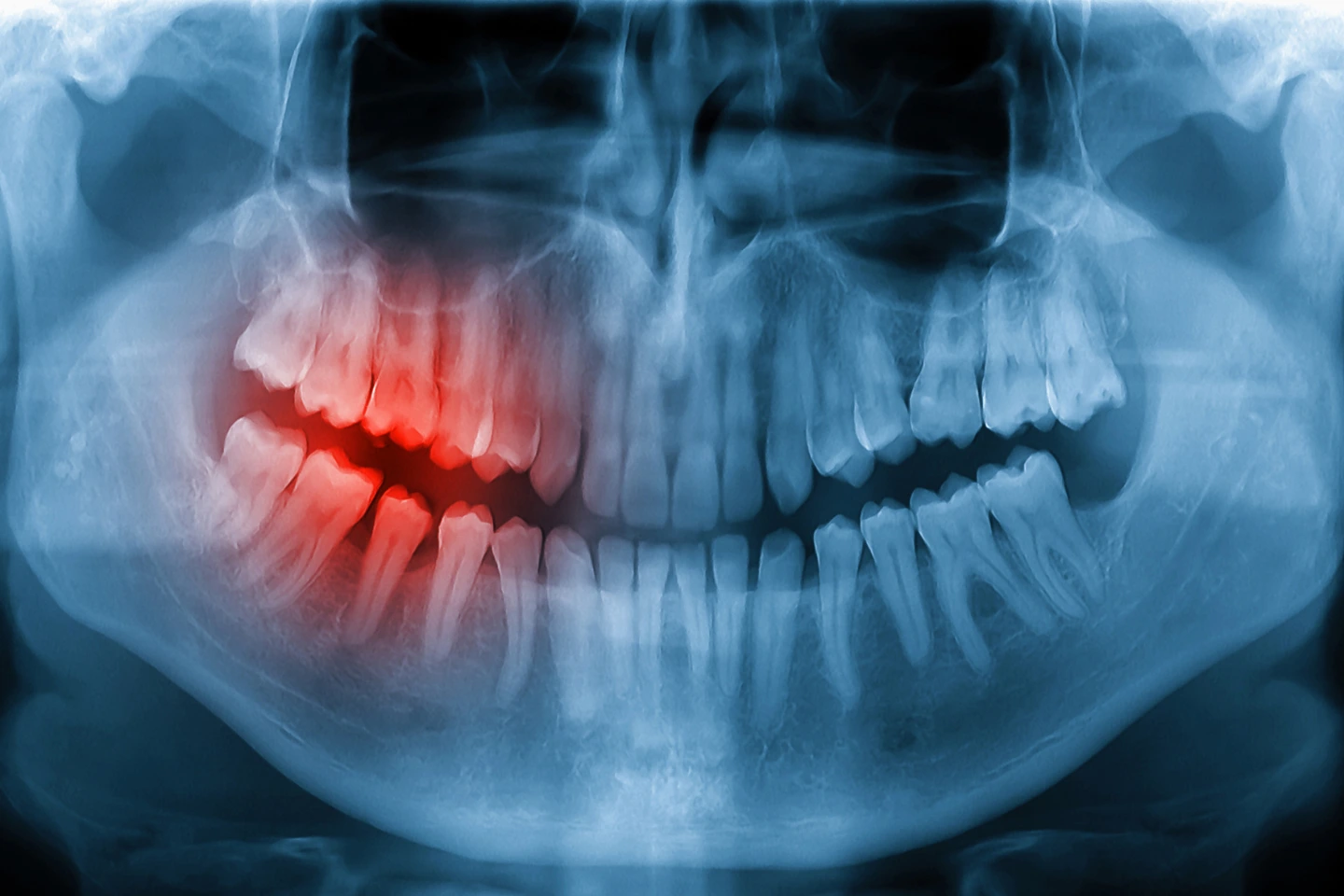 full mouth dental x ray