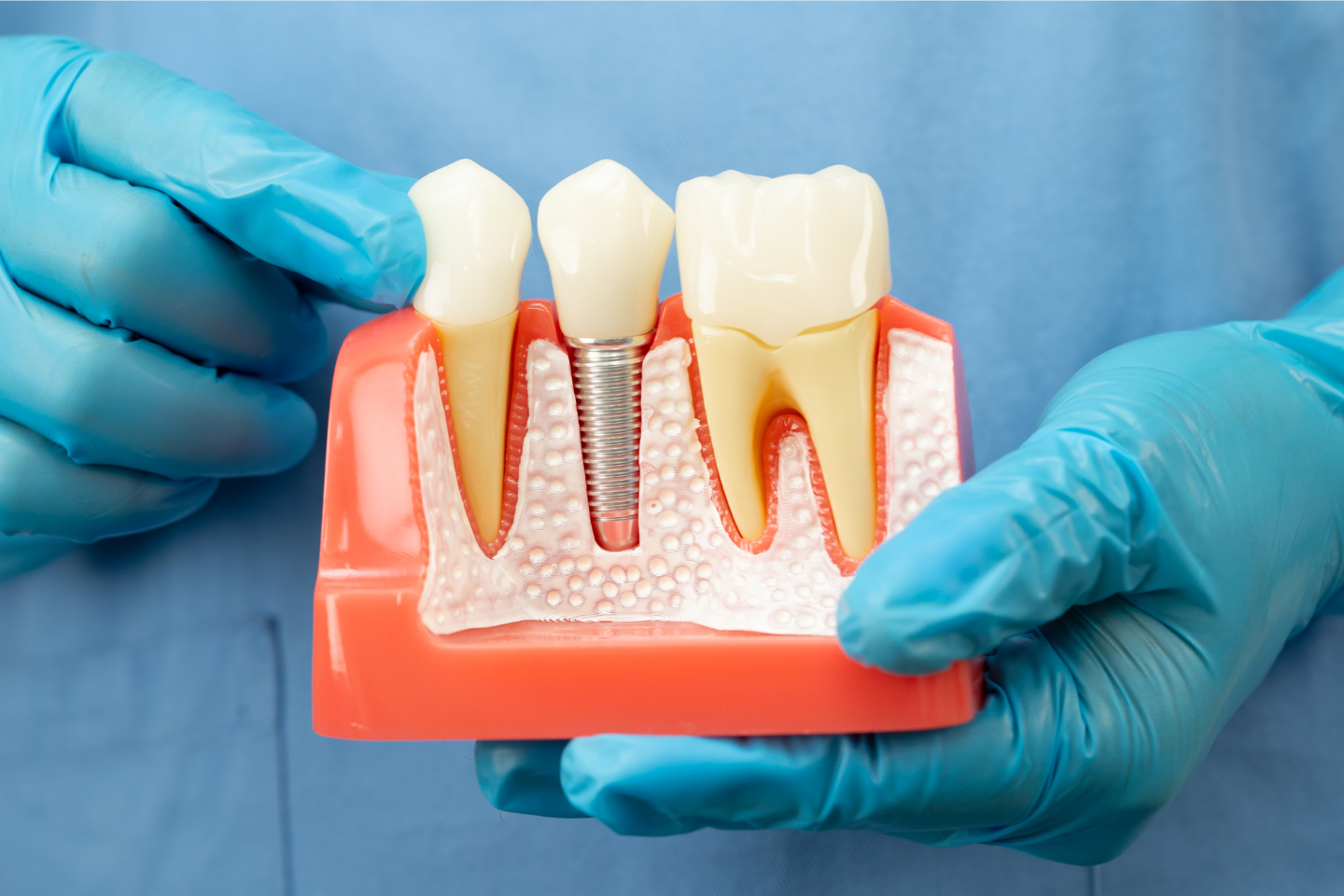 The Hidden Truth: What Is the Main Reason Dental Implants Fail?