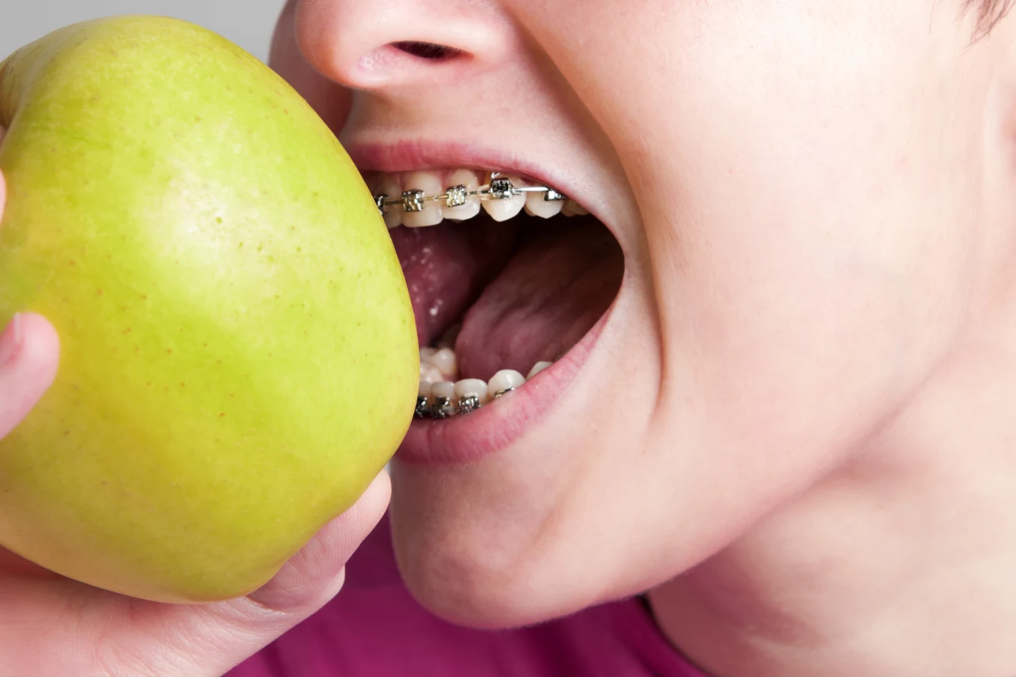 What Can You Eat with Braces? The Ultimate Survival Guide for Foodies