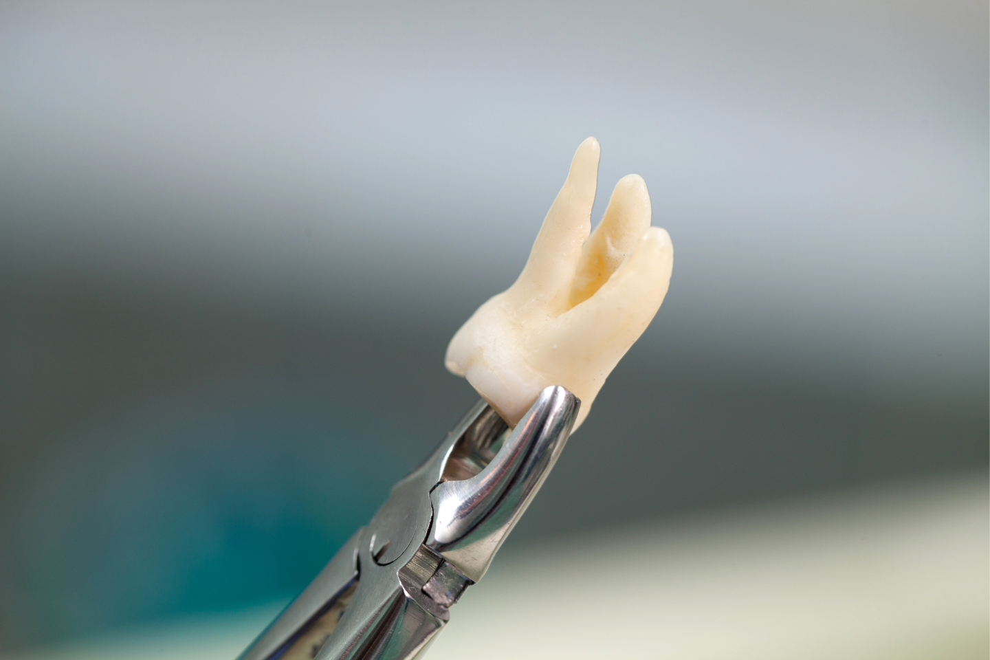 How Long Does a Tooth Extraction Take to Heal