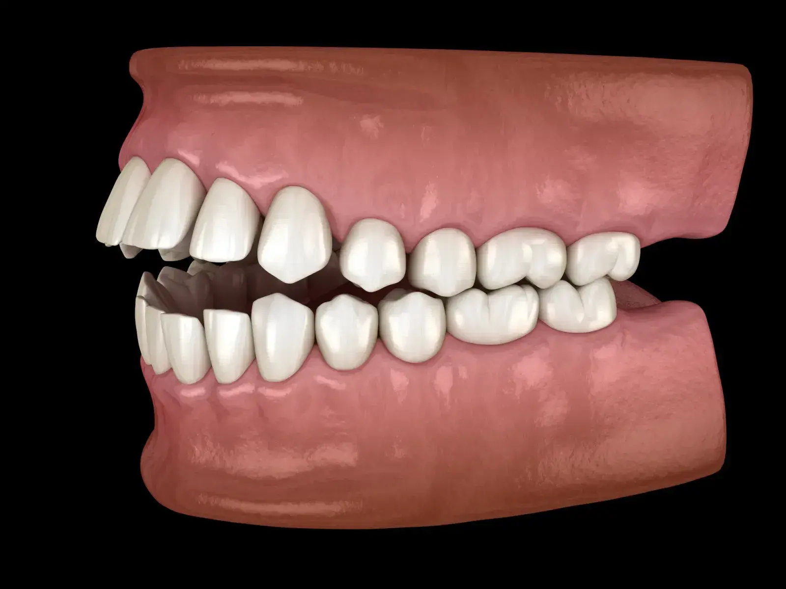 invisalign in Fremont