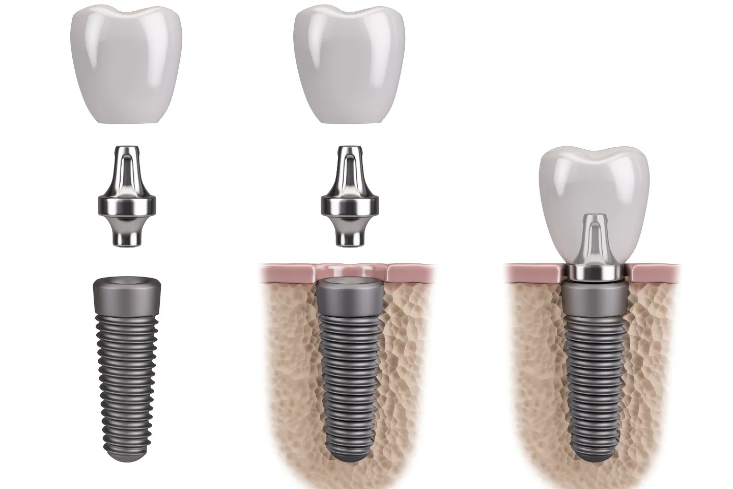 The Dental Implant Process: Step-by-Step From Consultation to Crown