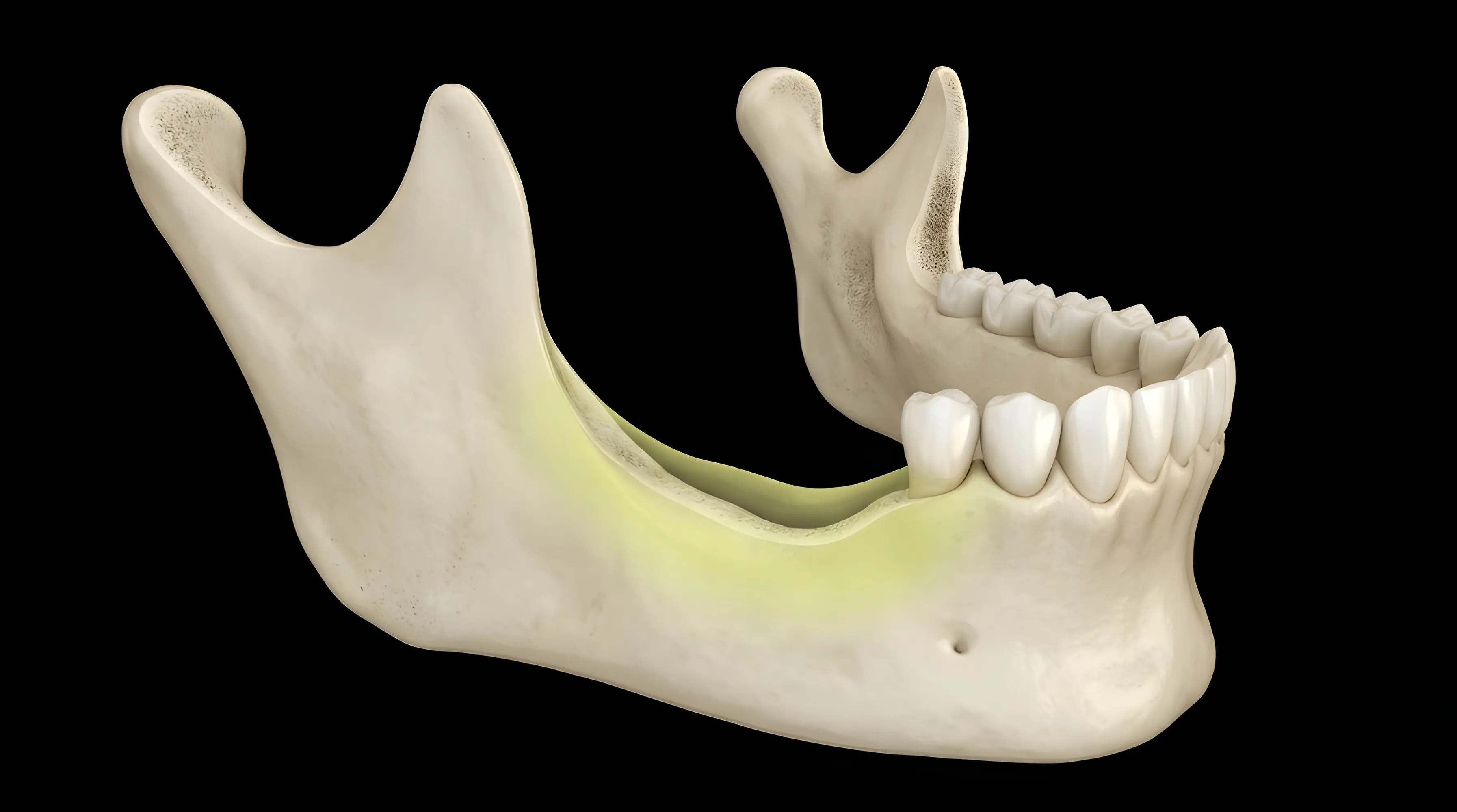 Significant Jawbone Loss