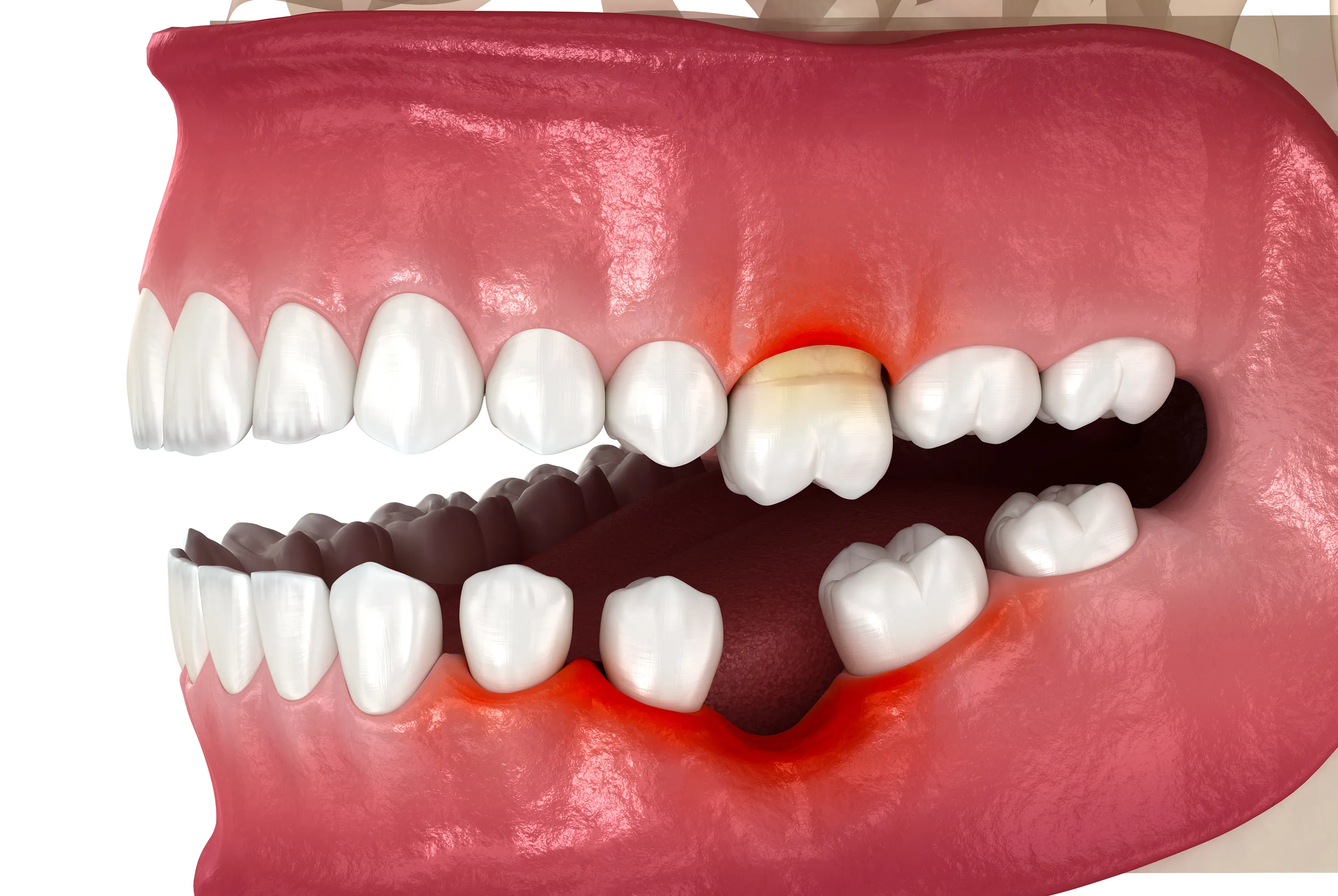 Advanced Gum Disease Leading to Tooth Loss