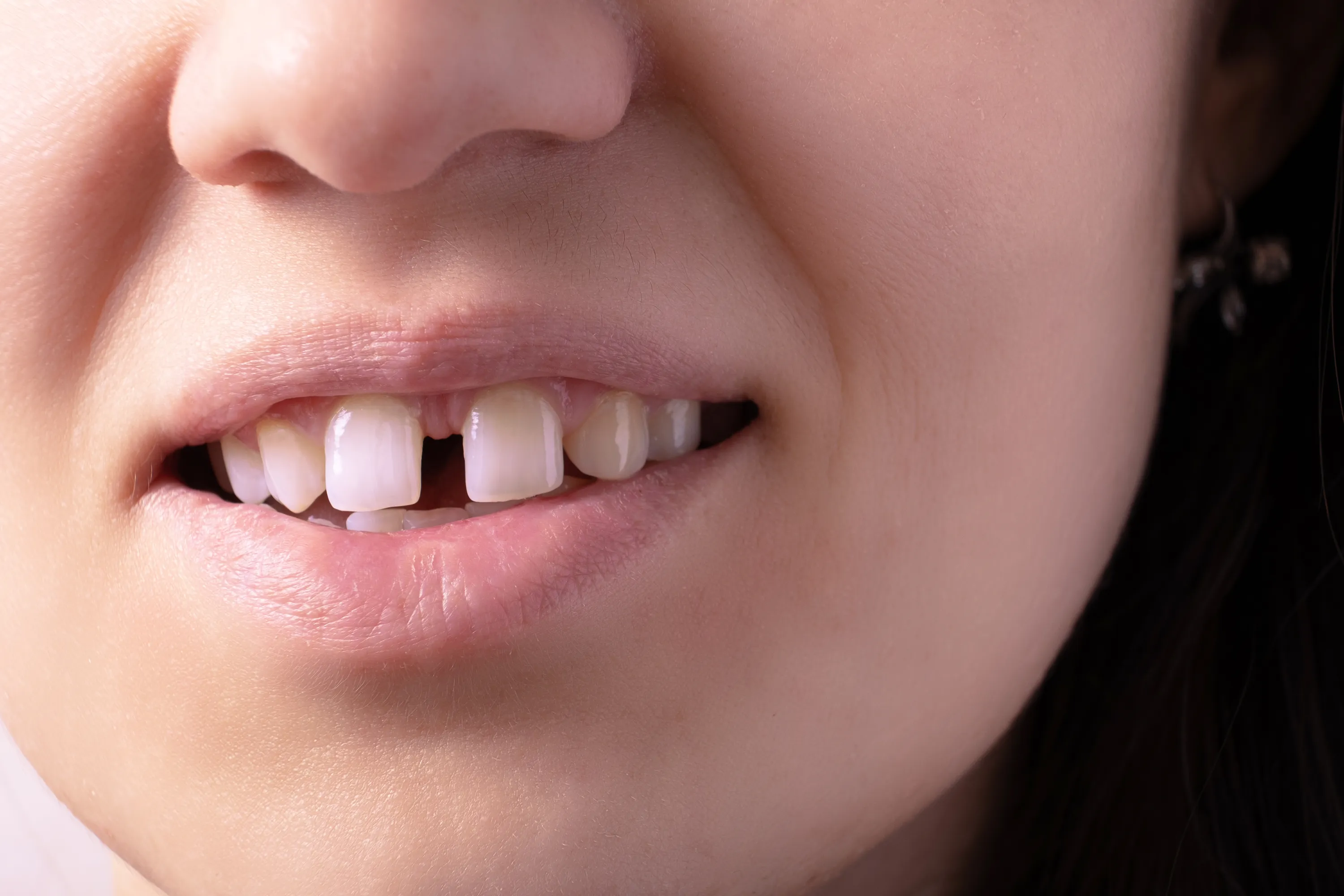 A Visible Front Tooth Gap