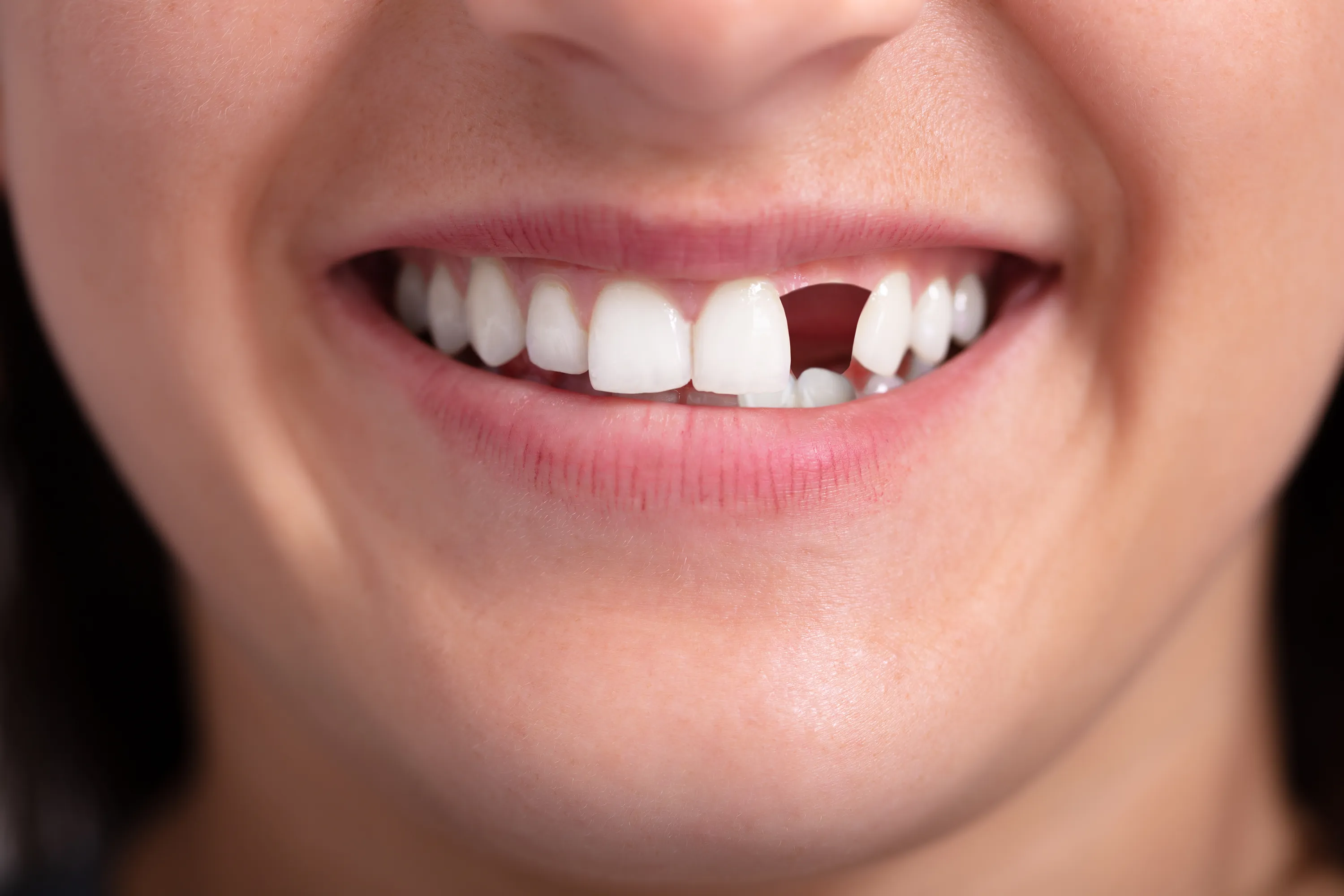 A Long-Standing Gap With Bone Loss