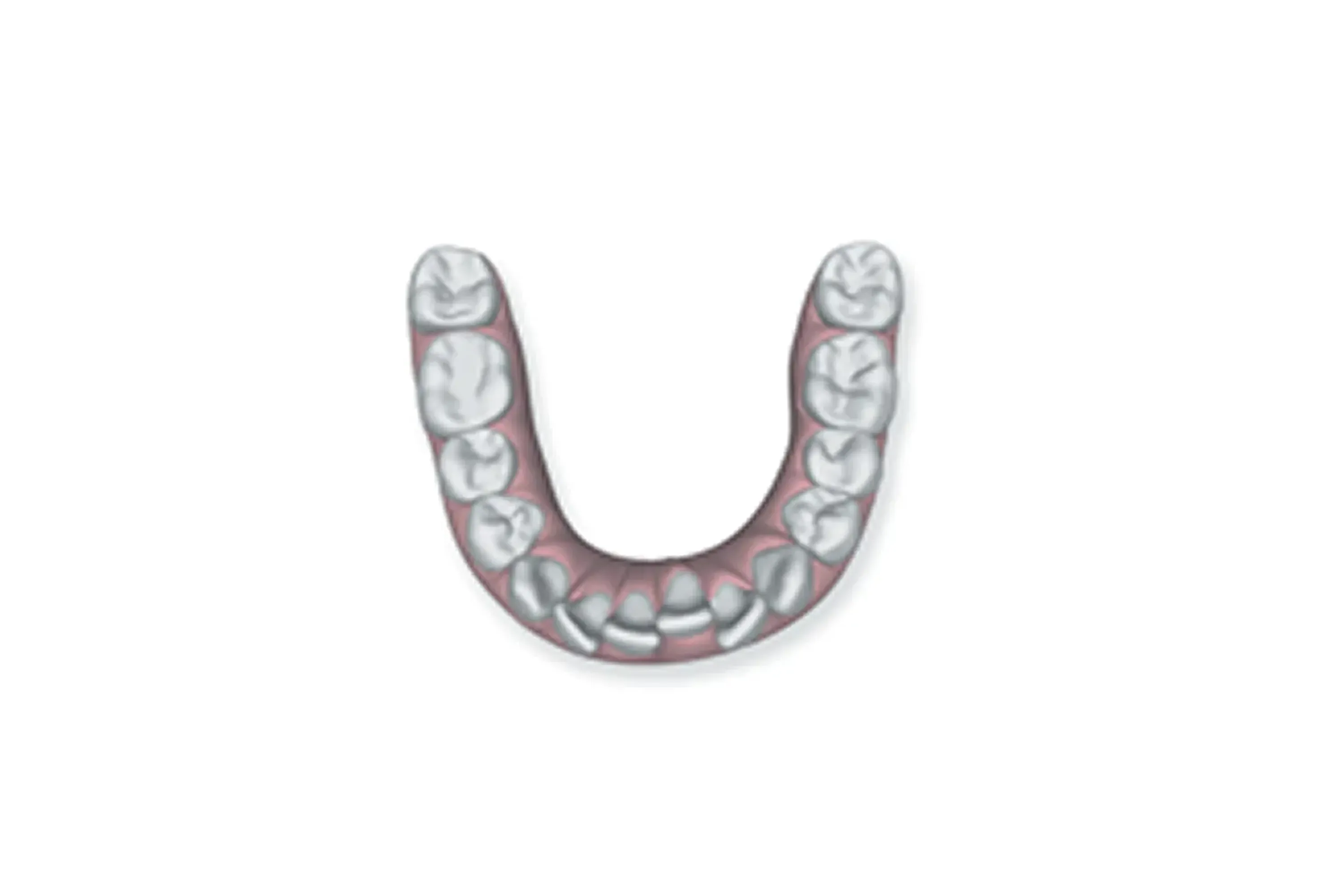 Overly crowded teeth