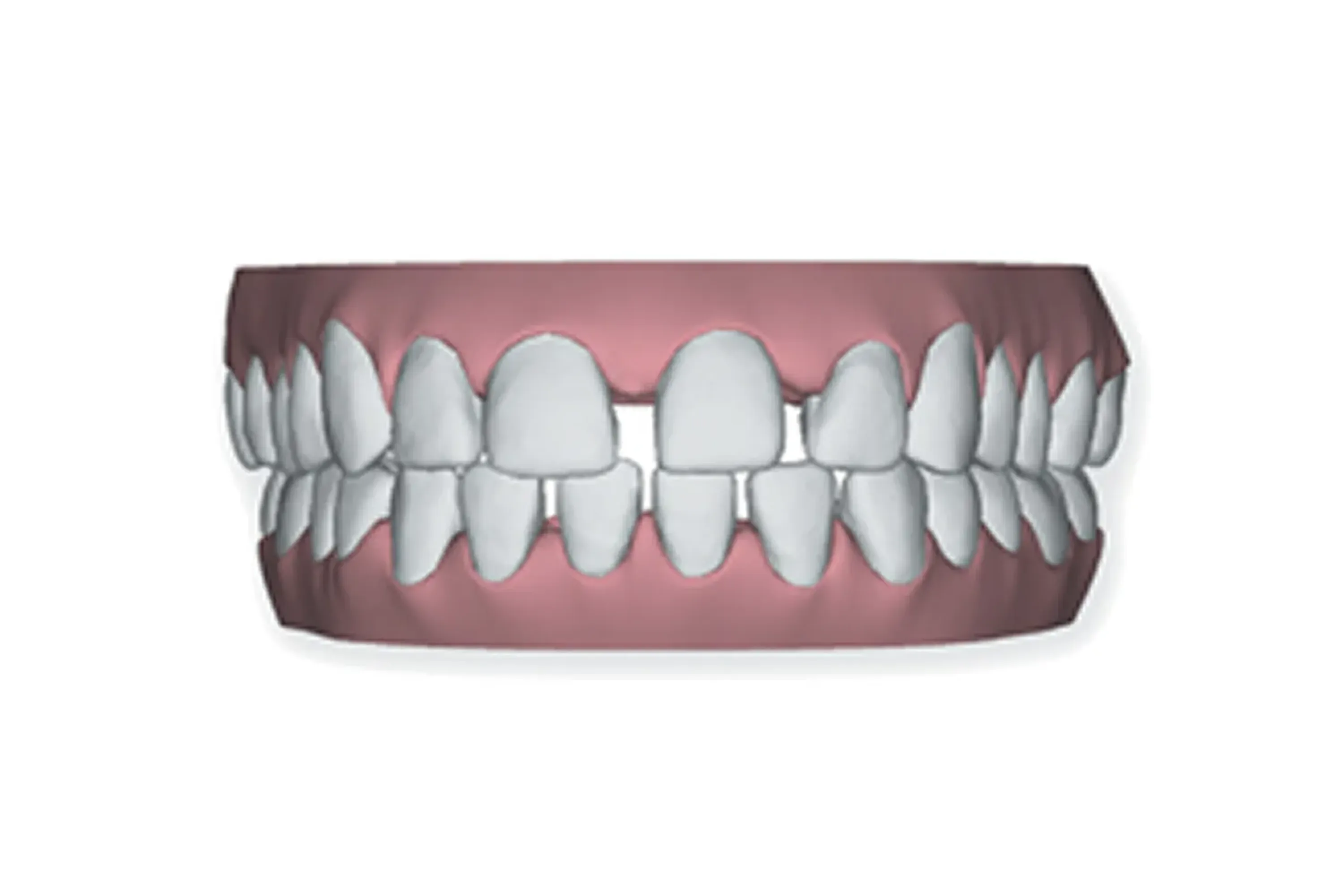 Widely spaced teeth