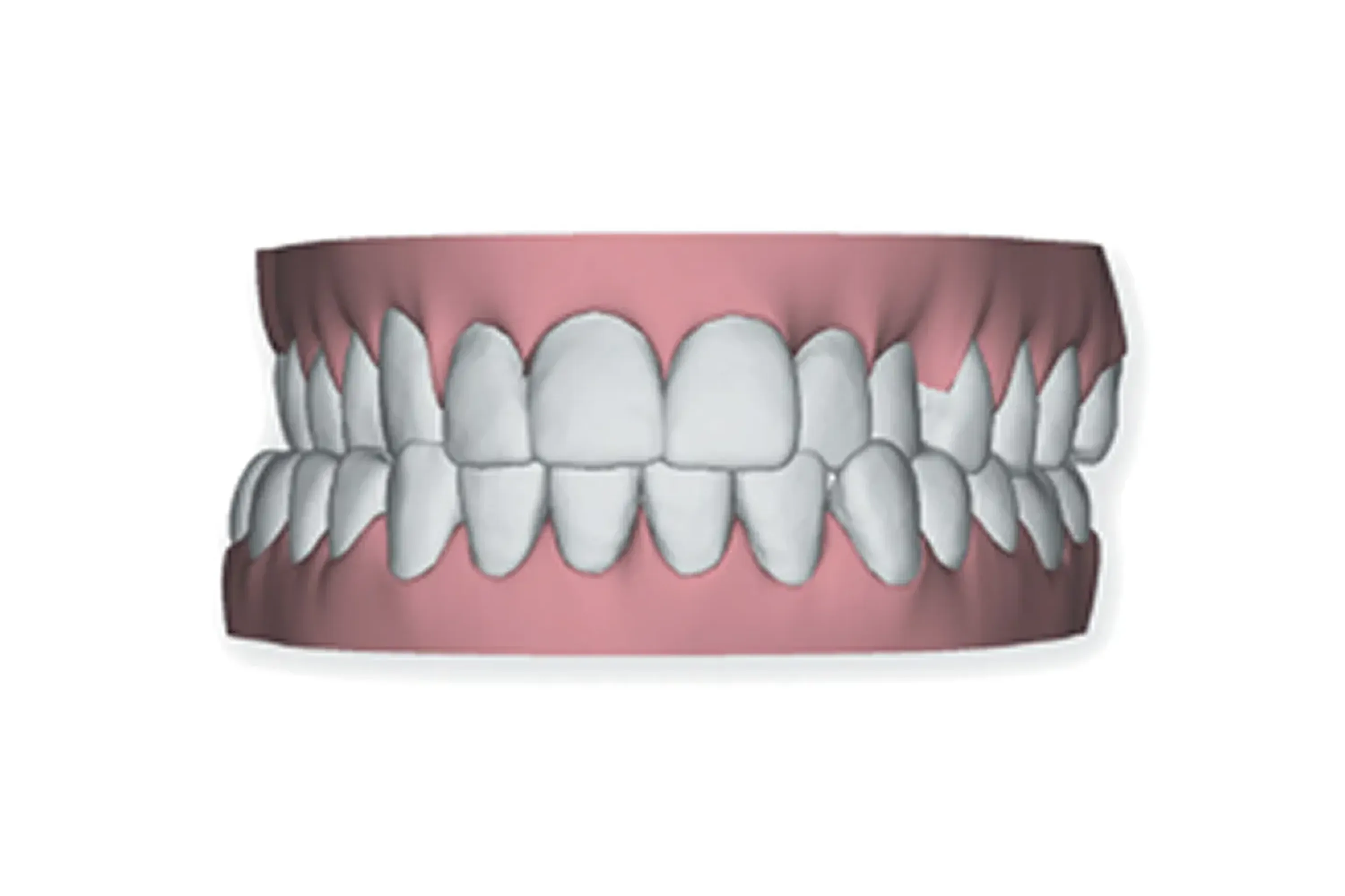 Crossbite
