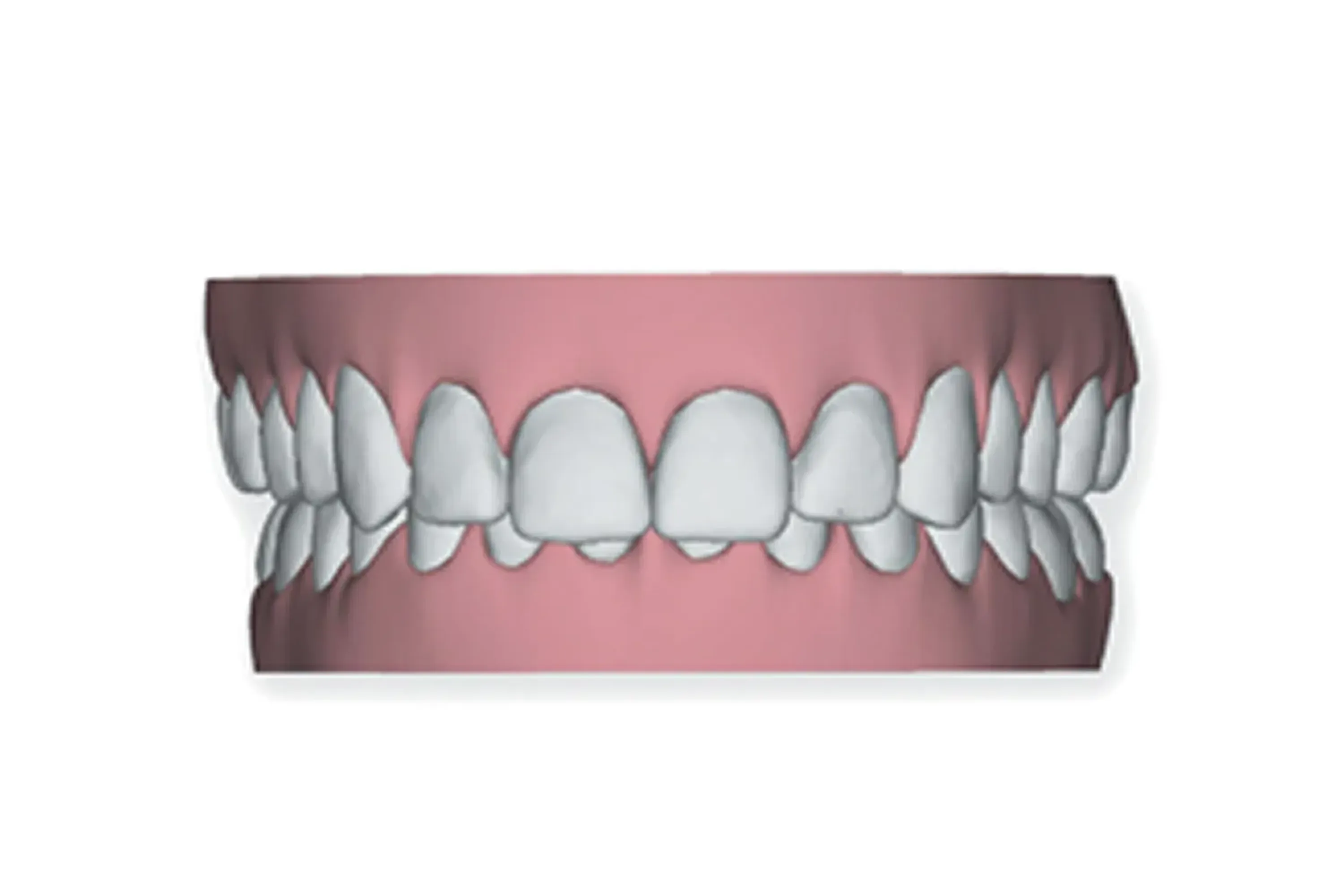 Overbite