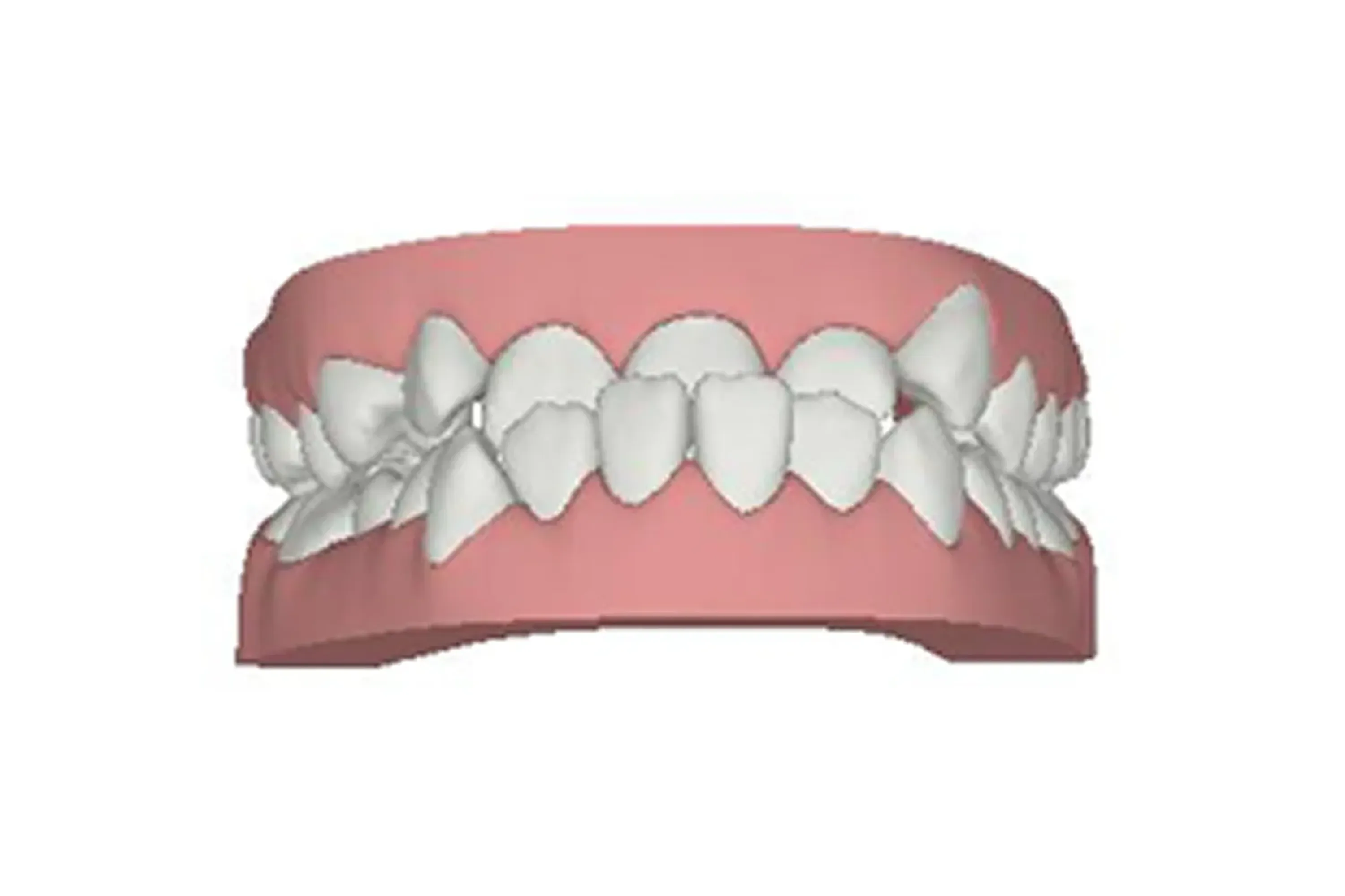 Underbite