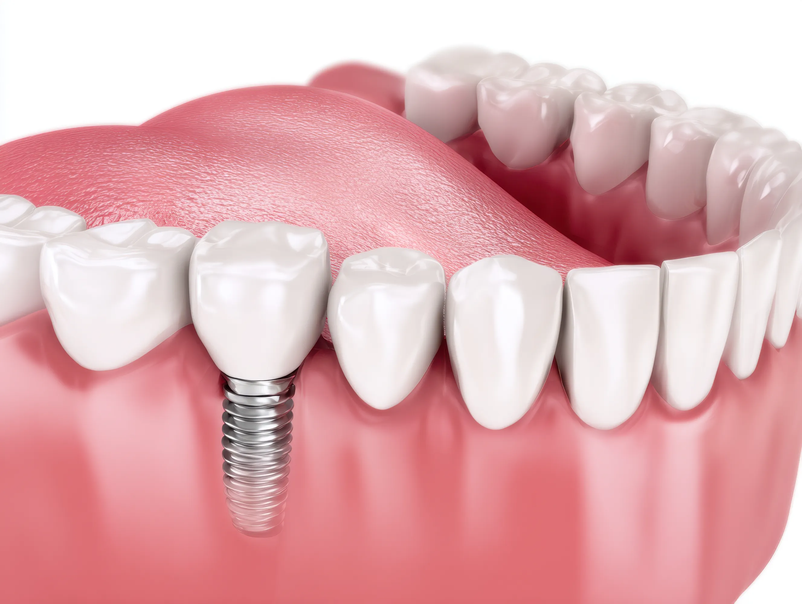 3D illustration of a single tooth implant in the lower jaw