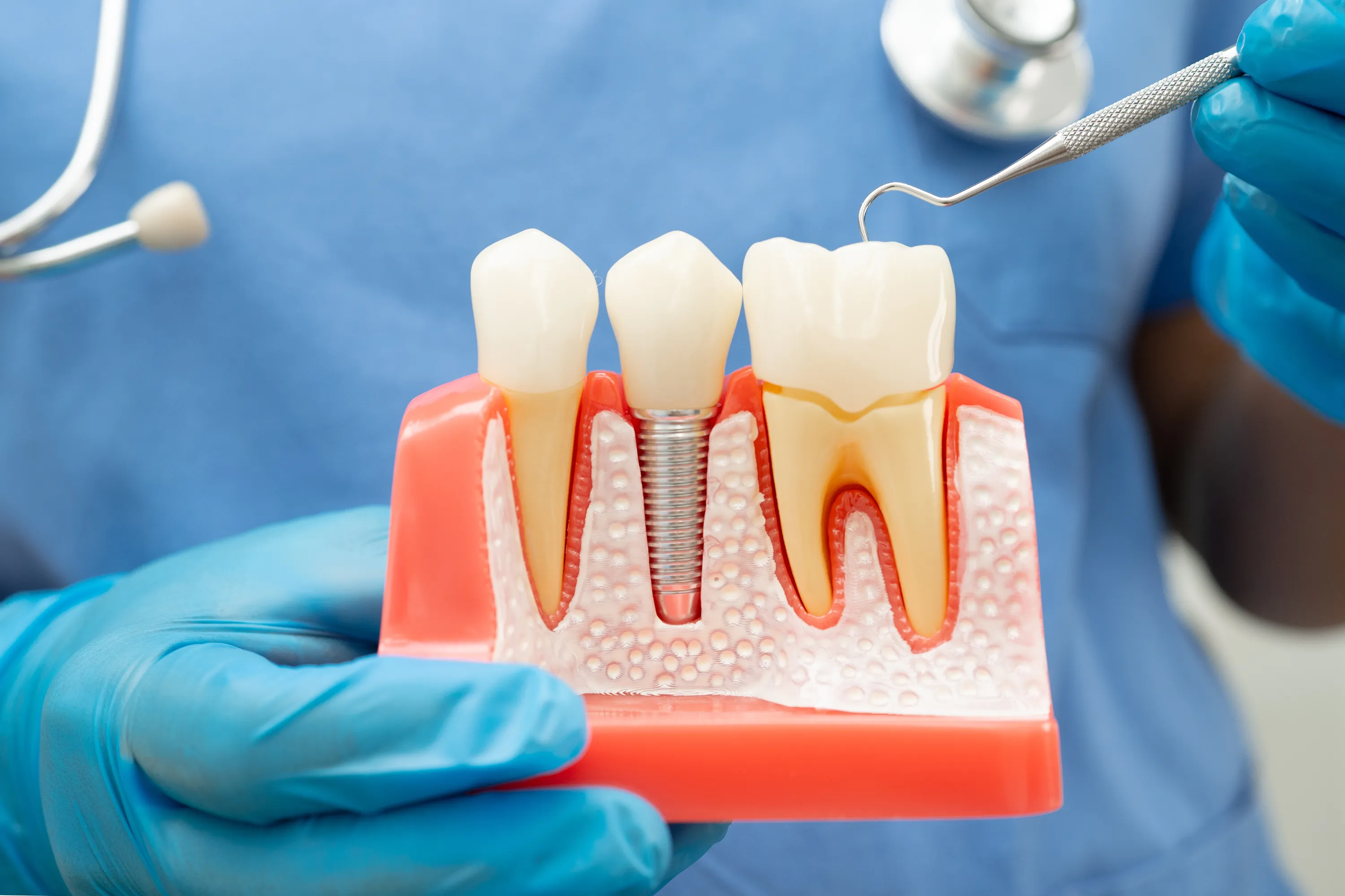 Dentist holding a model comparing an implant with natural tooth roots