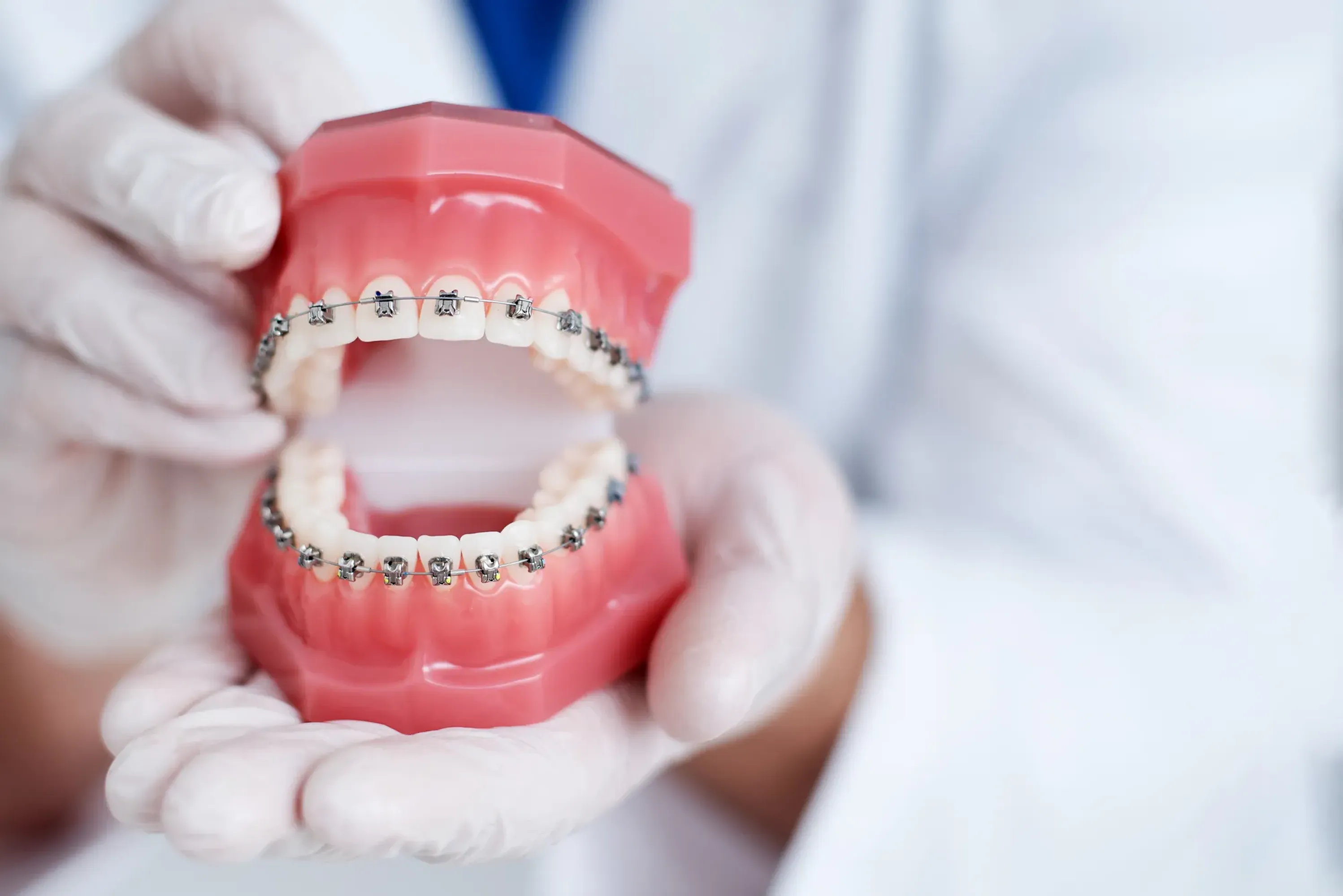 Dental model of upper and lower teeth with metal braces