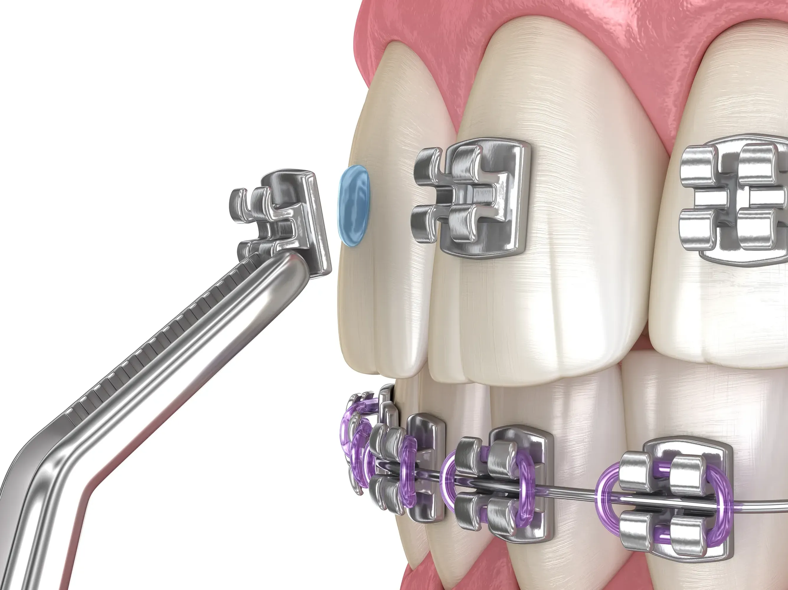 3D illustration of a metal bracket being placed on a tooth