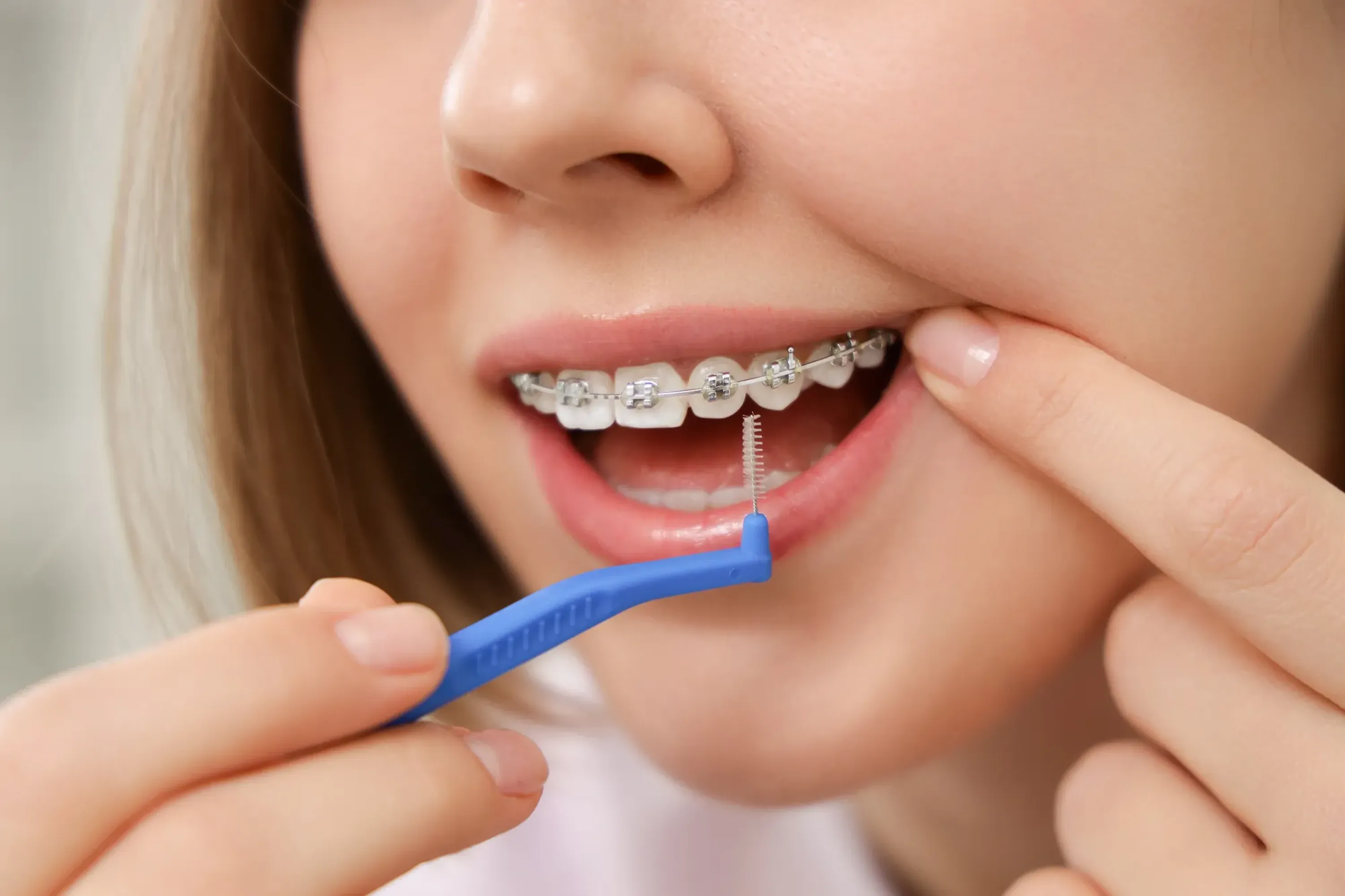 Woman cleaning around her braces with an interdental brush