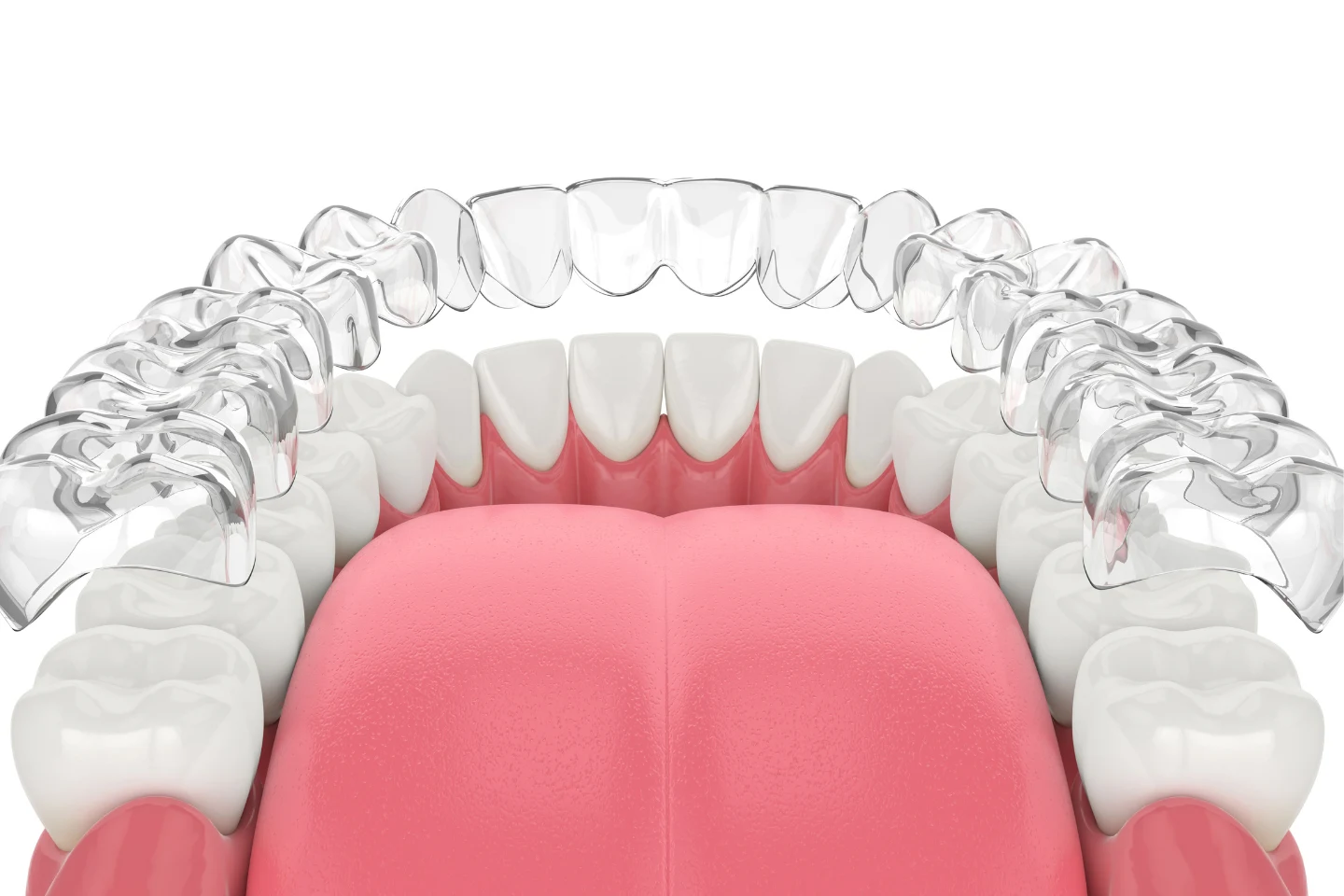 Does MetLife Insurance Cover Invisalign for Adults?