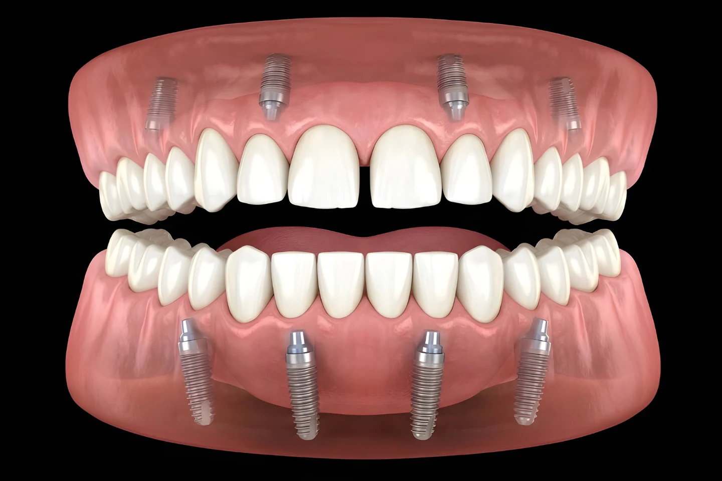 Who Is a Good Candidate for Dental Implants? Key Criteria