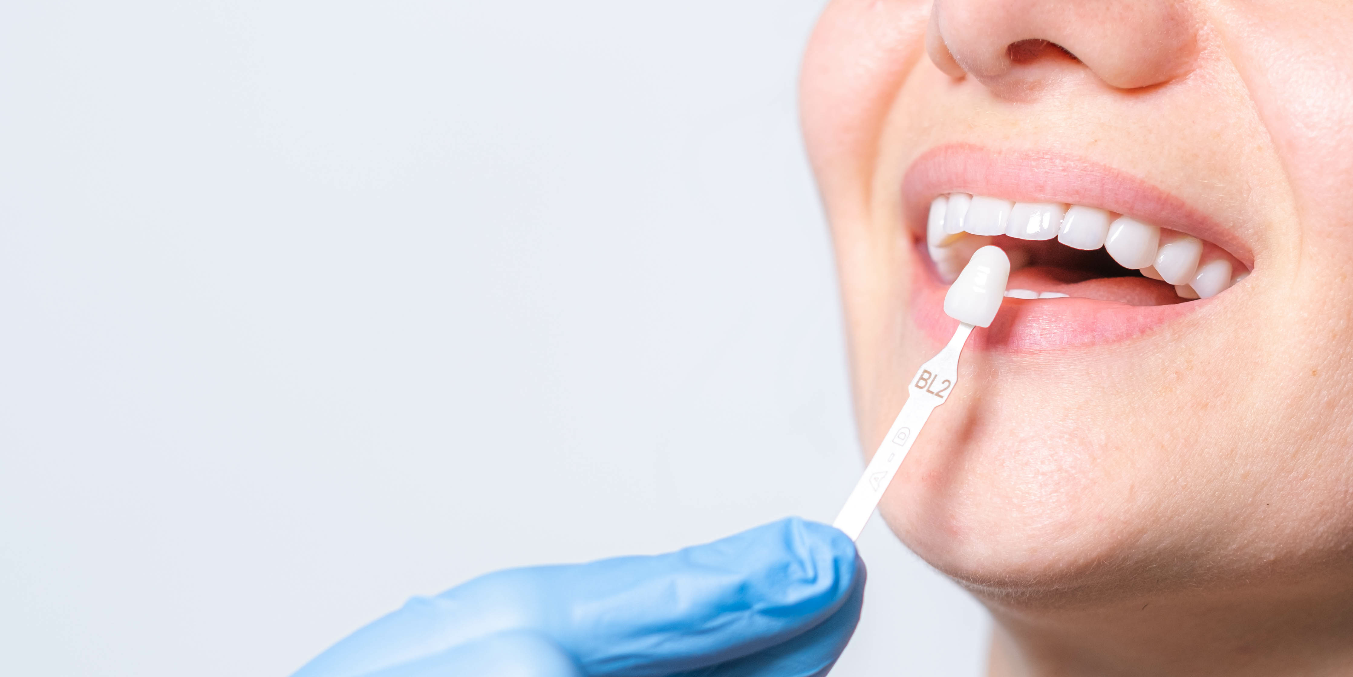 Dentist matching a porcelain veneer shade to a patient's teeth