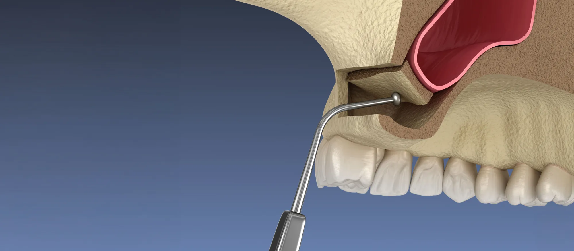 3D illustration of a sinus lift raising the sinus membrane above the upper jaw