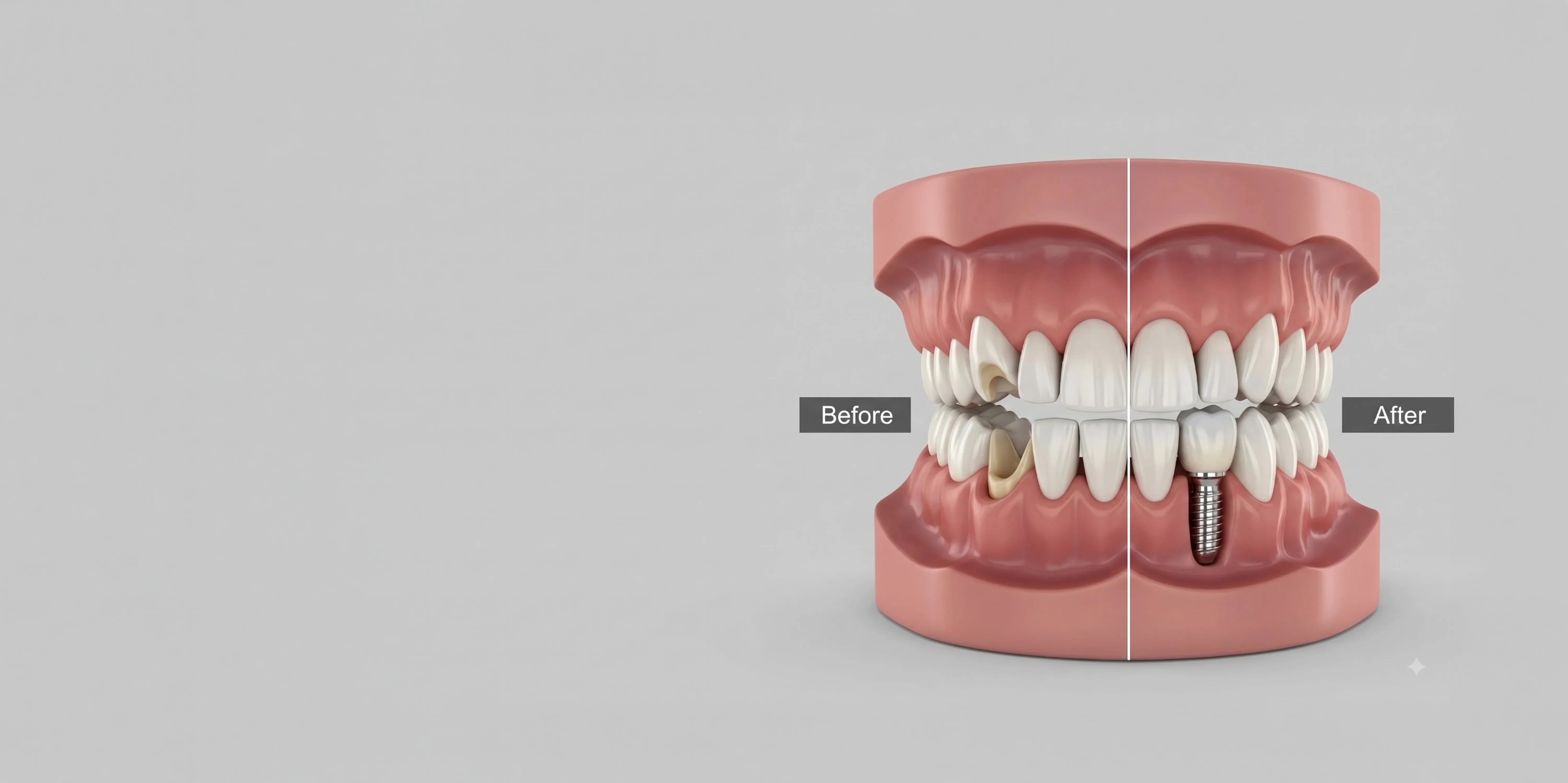 Before and after illustration of a damaged tooth replaced with an implant