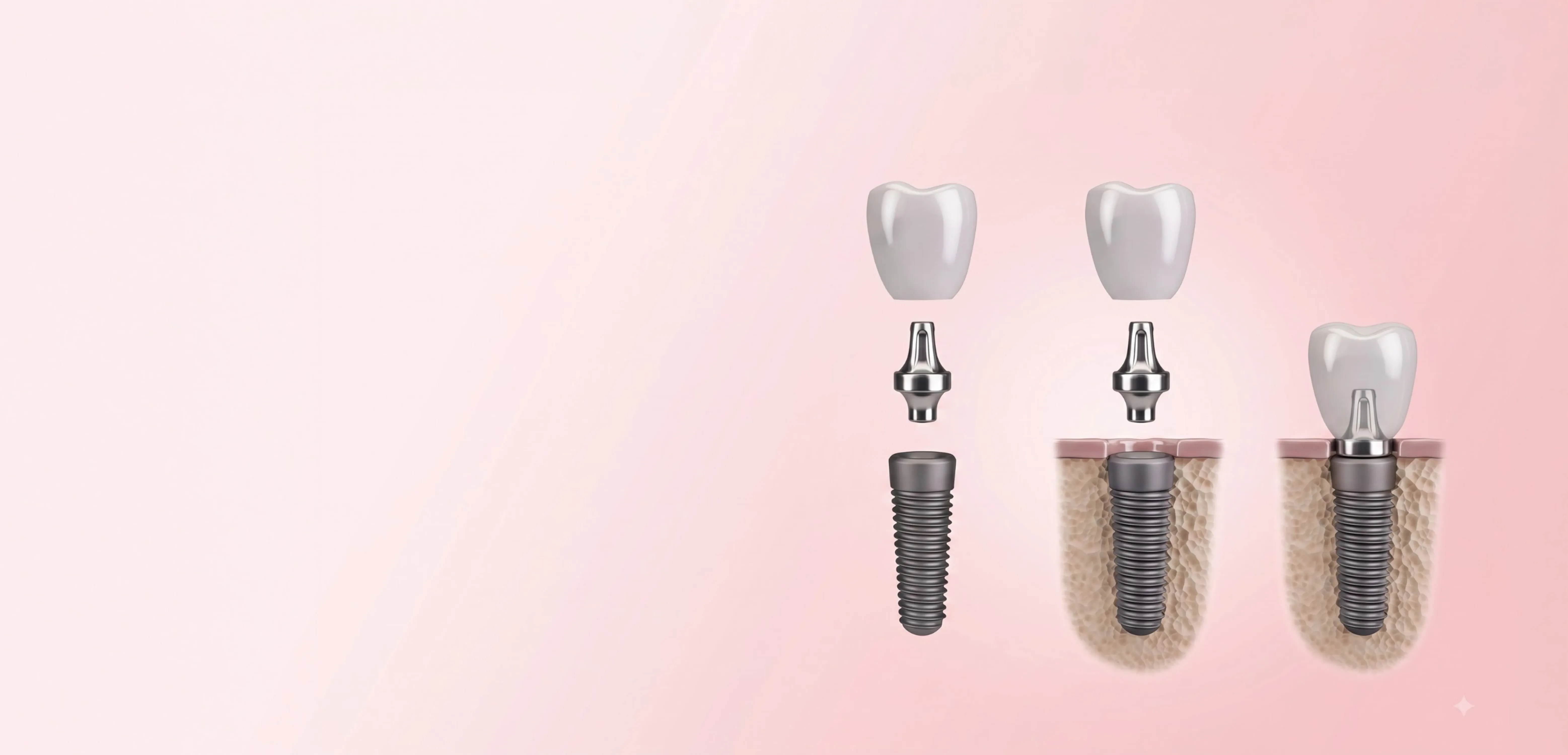 Stages of a single tooth implant: post, abutment and crown