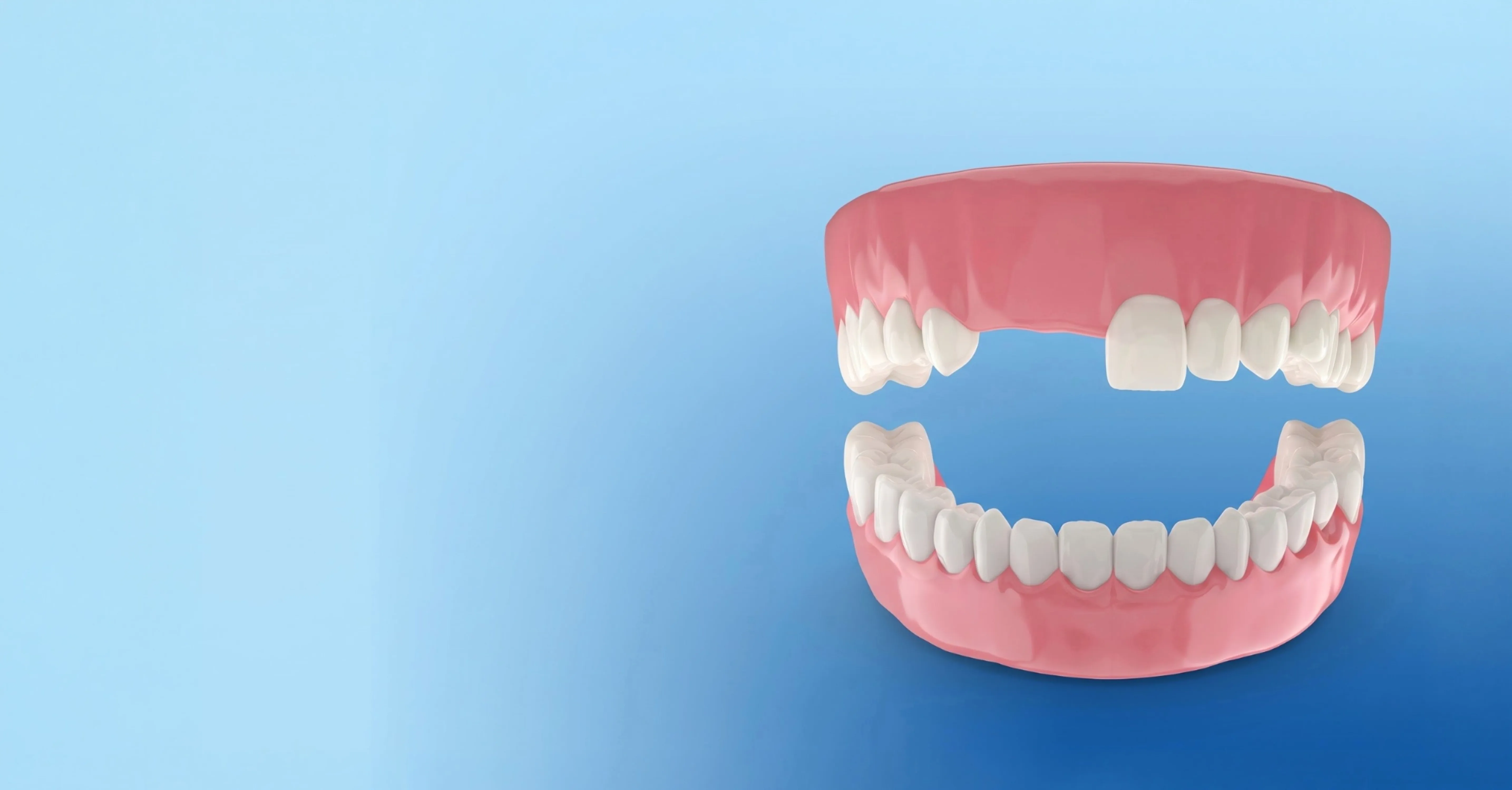 Dental model showing a gap from a missing front tooth