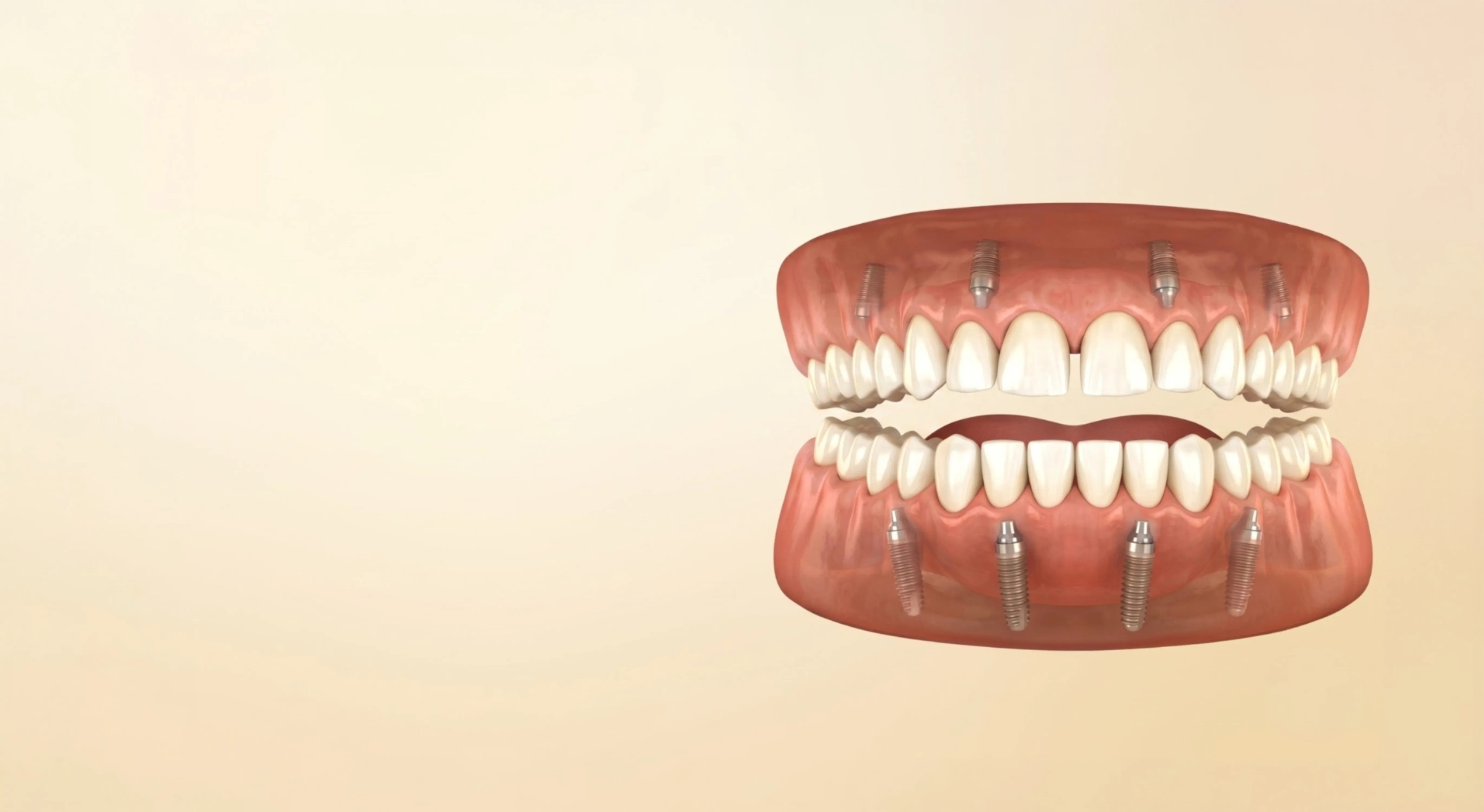 3D illustration of full-arch implants supporting upper and lower teeth