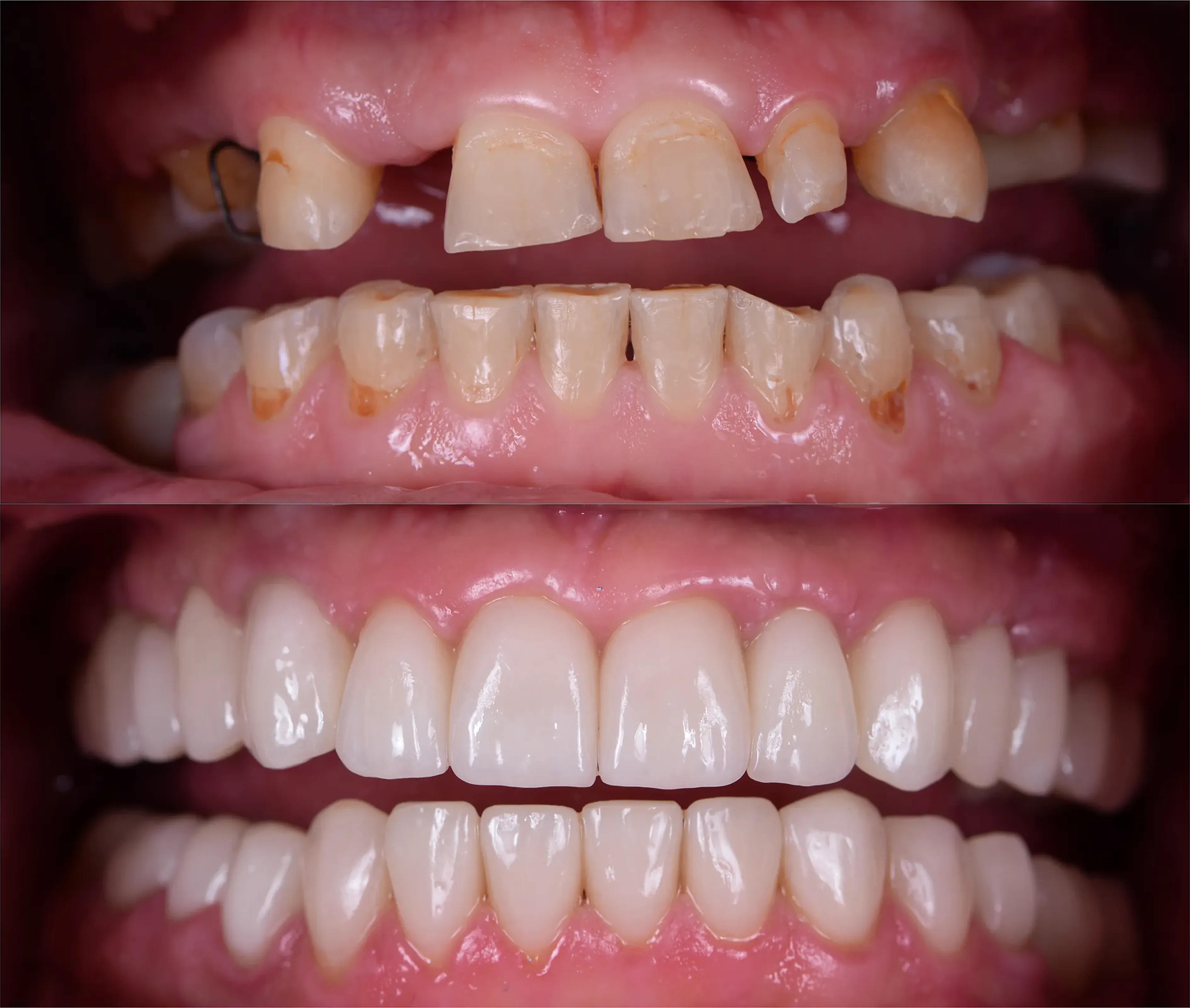 Before and after full mouth implant restoration of worn teeth
