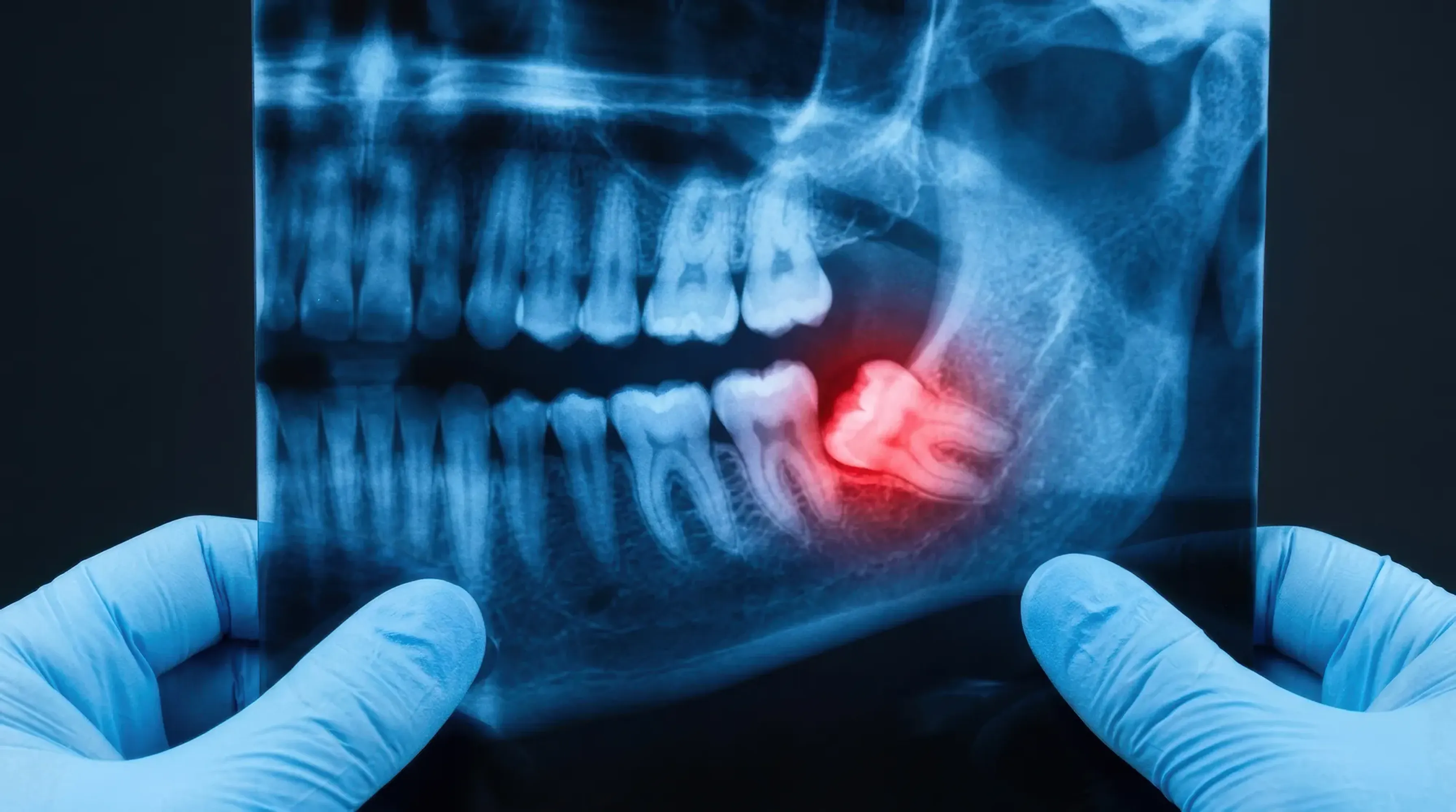 Impacted Wisdom Teeth