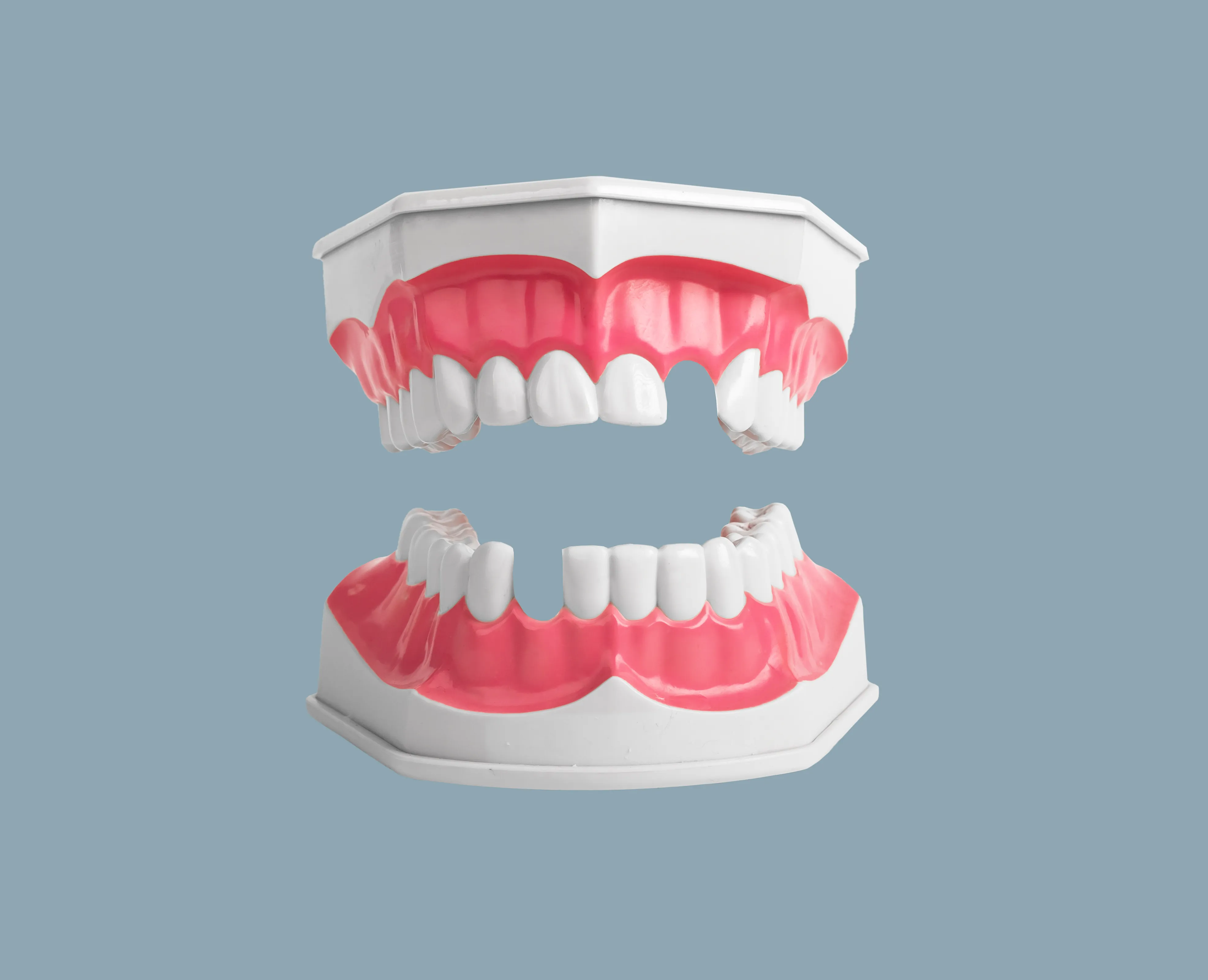 Multiple Missing Teeth Across an Arch