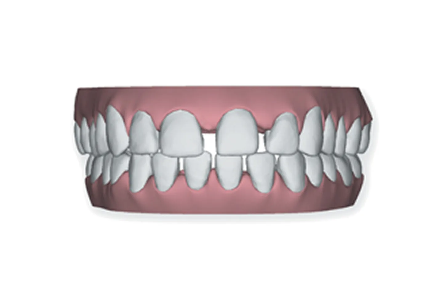 Gapped Teeth