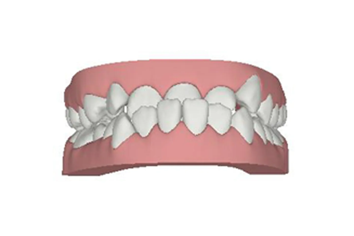 Underbite