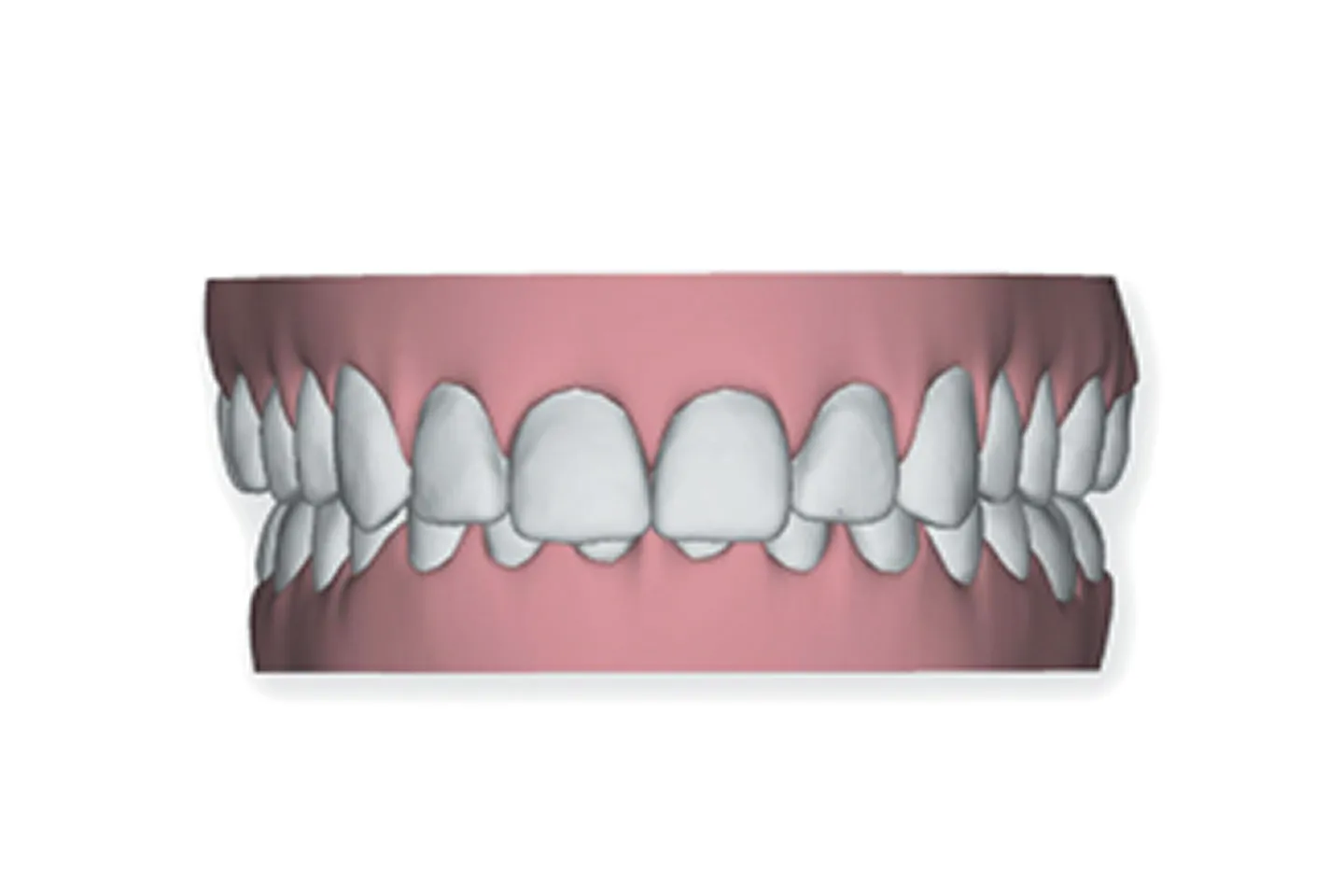 Overbite