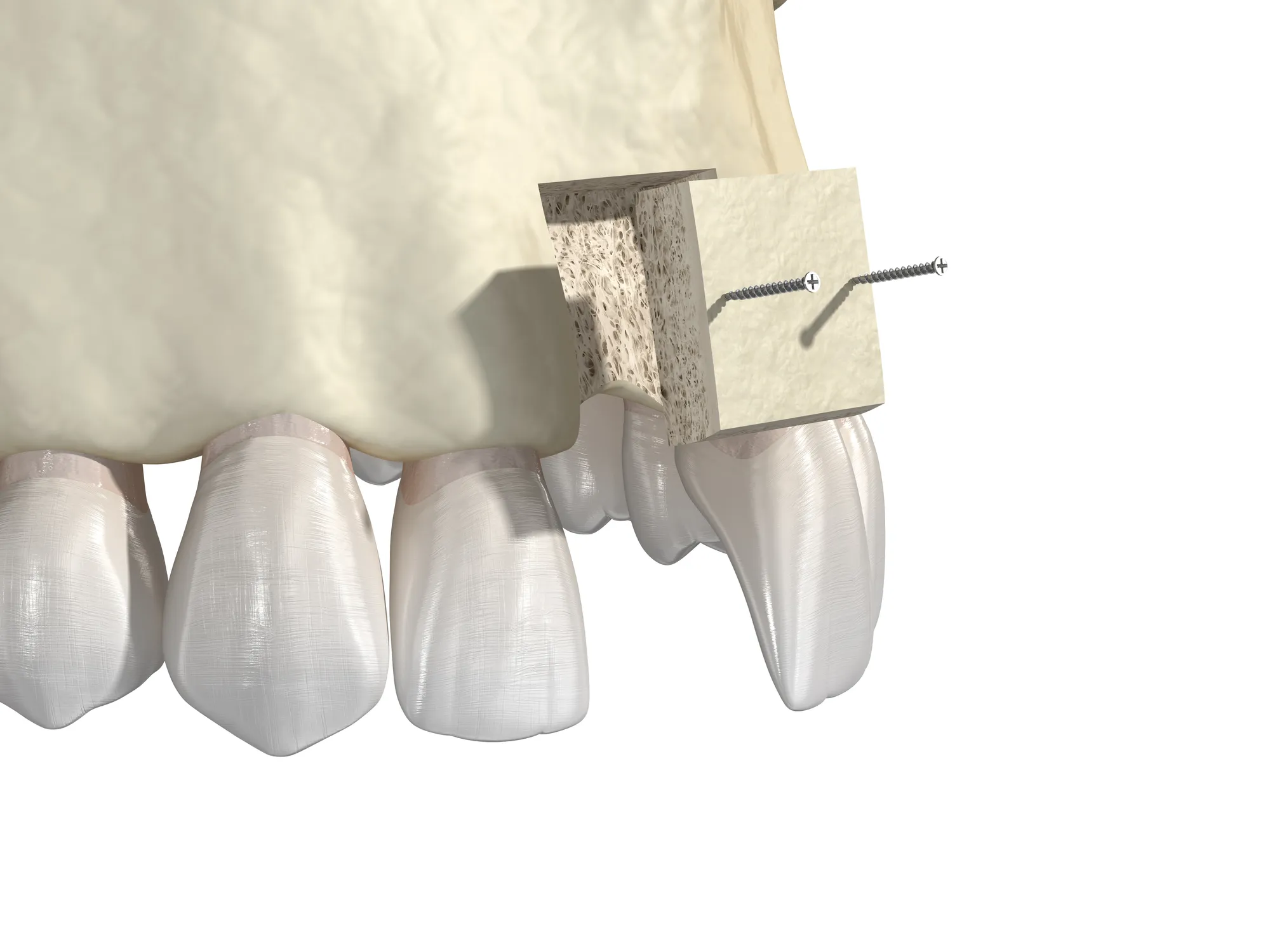 Block Bone Graft