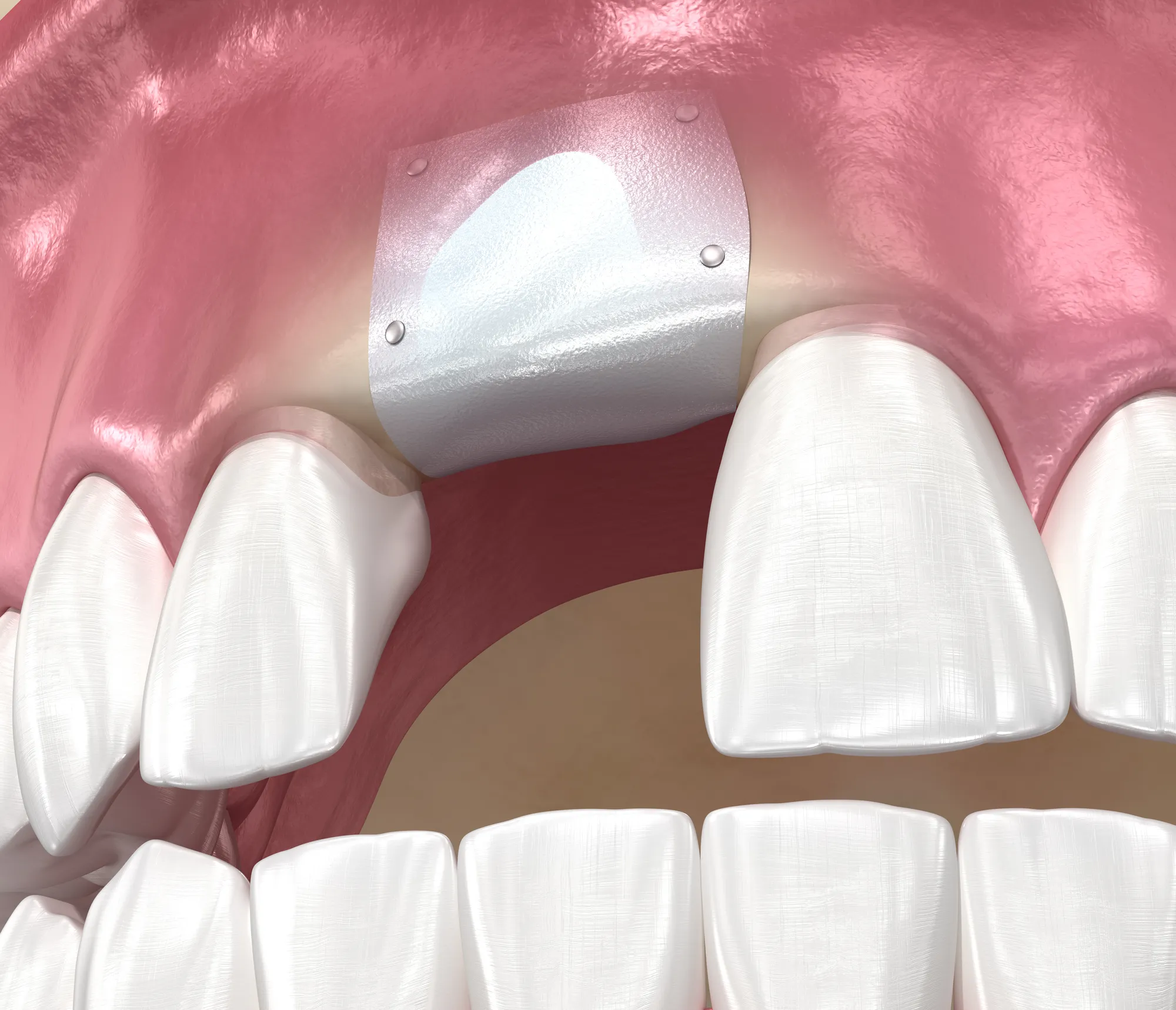 Socket Preservation