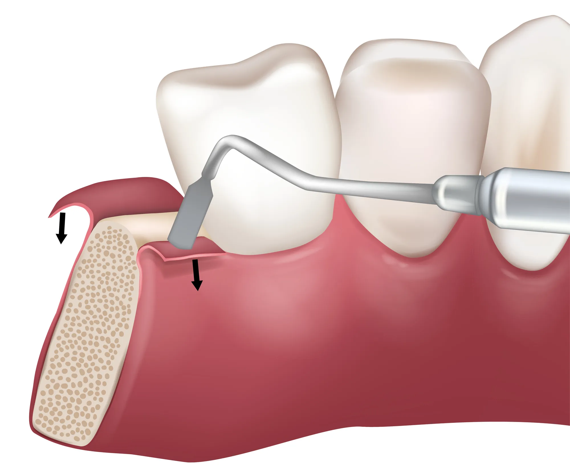 Guided Bone Regeneration