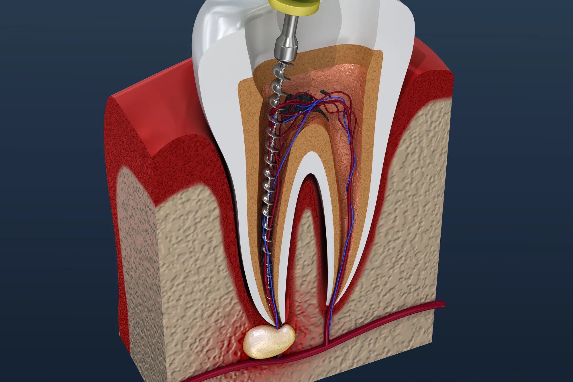 After Root Canal