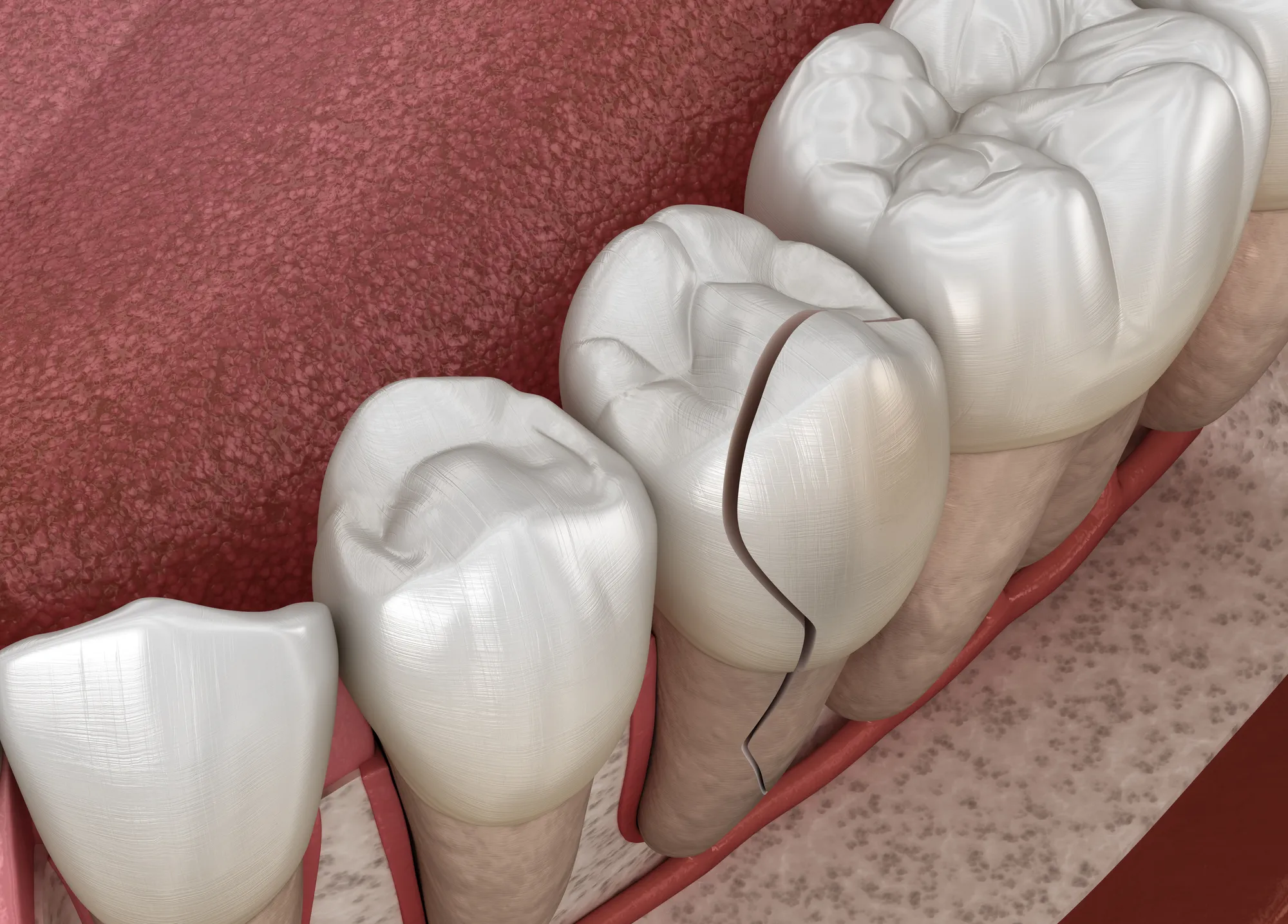 For Broken Teeth