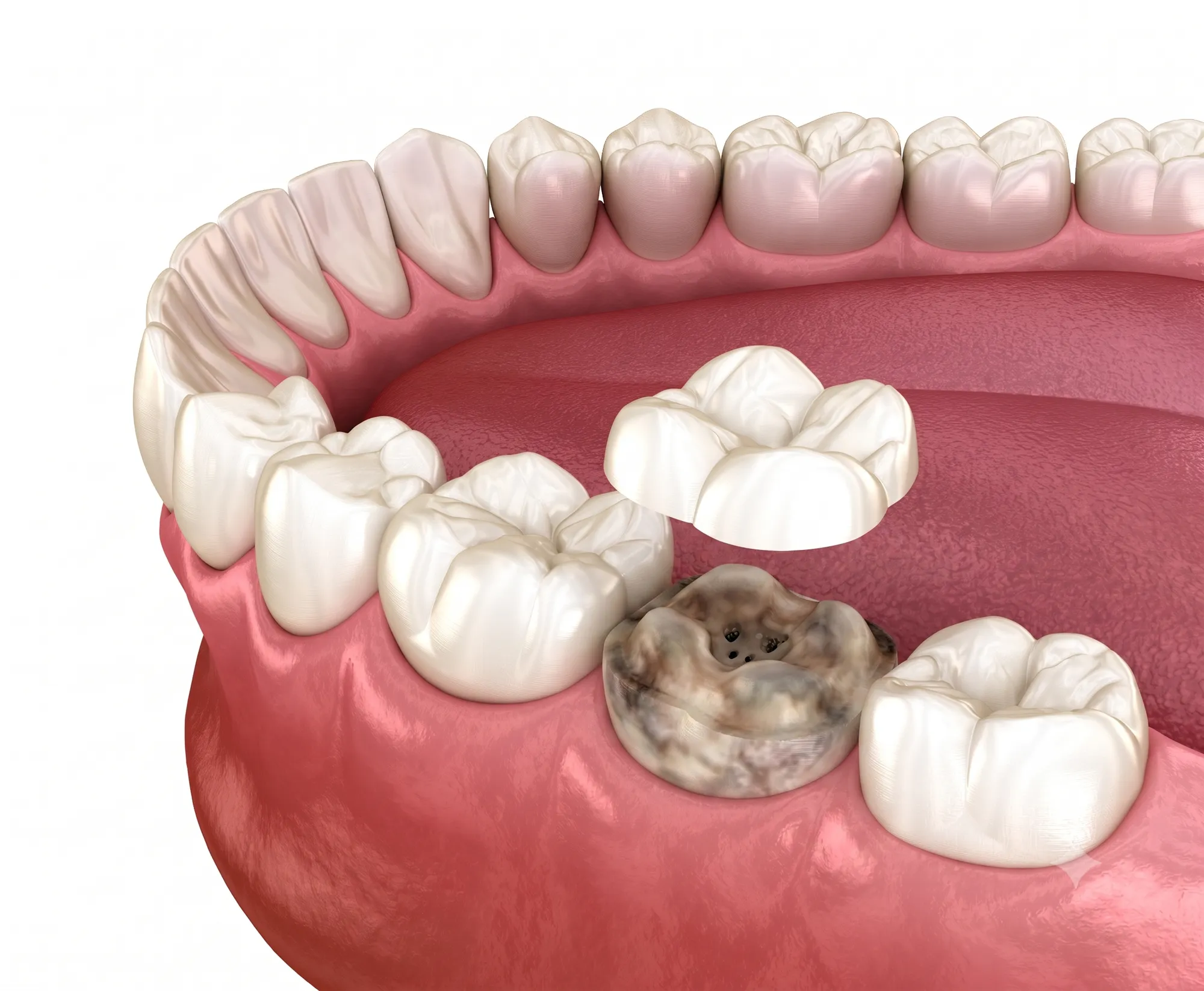 For Worn Teeth