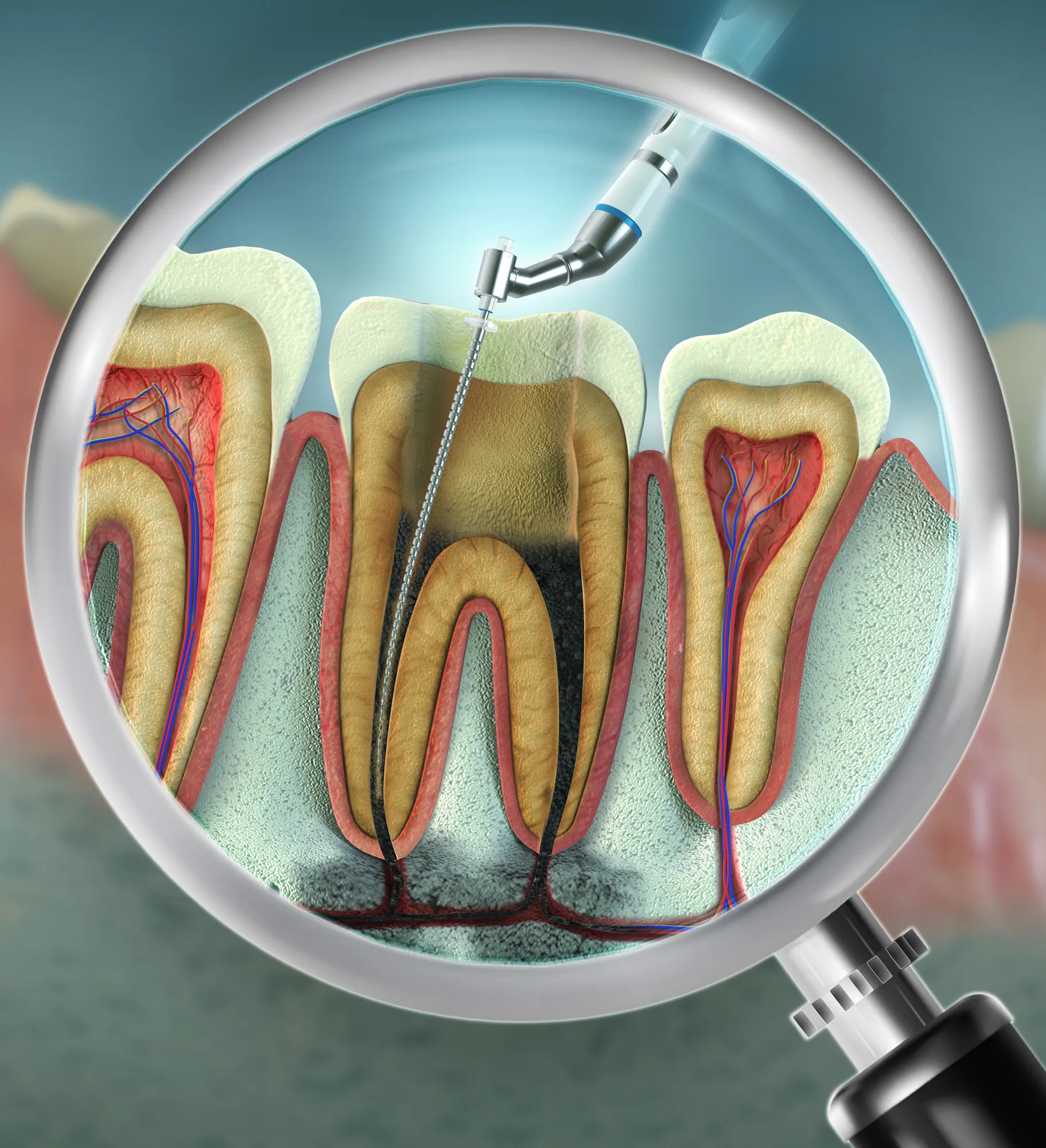 Pulp Removal