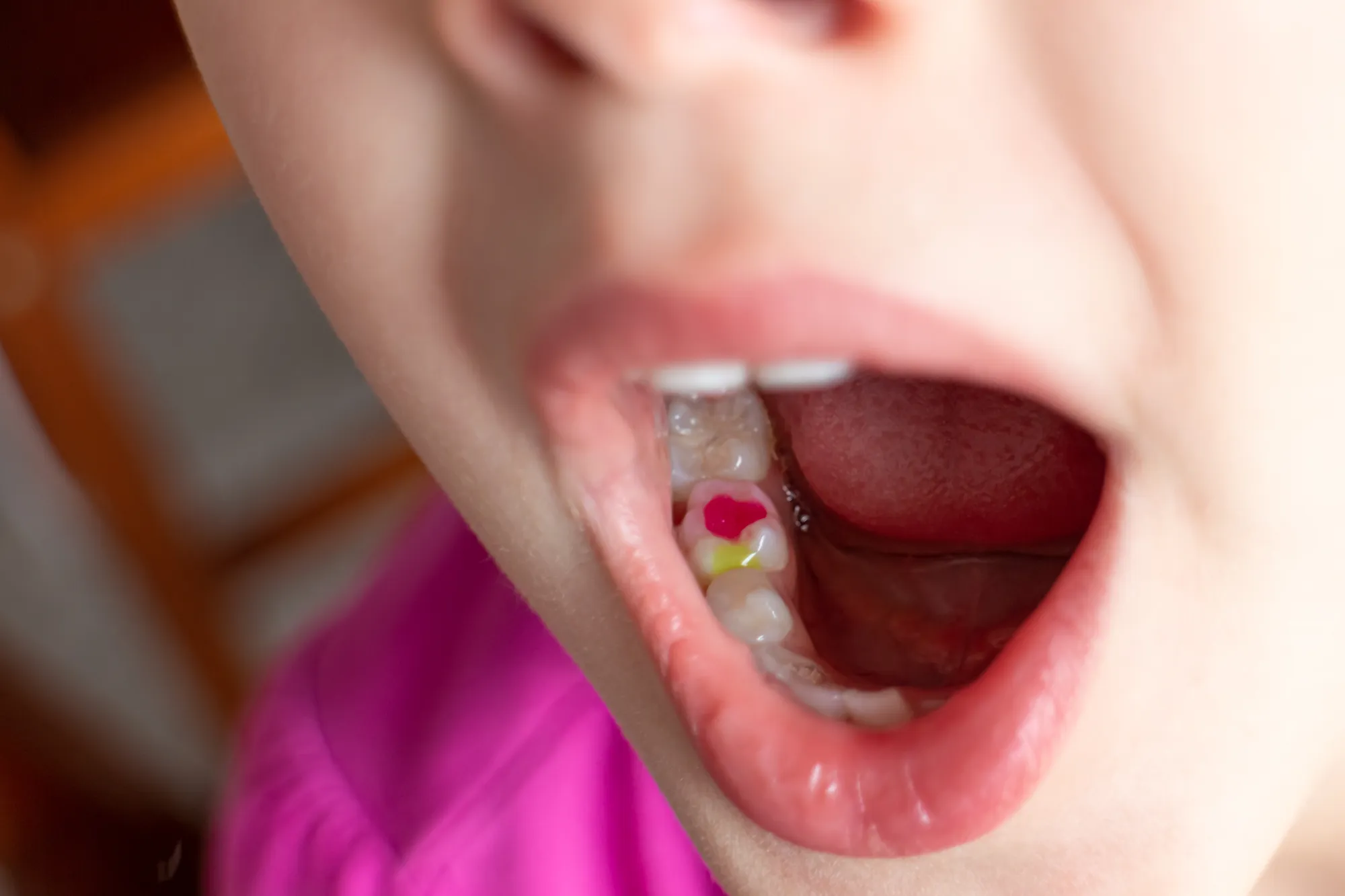 Dental Sealants