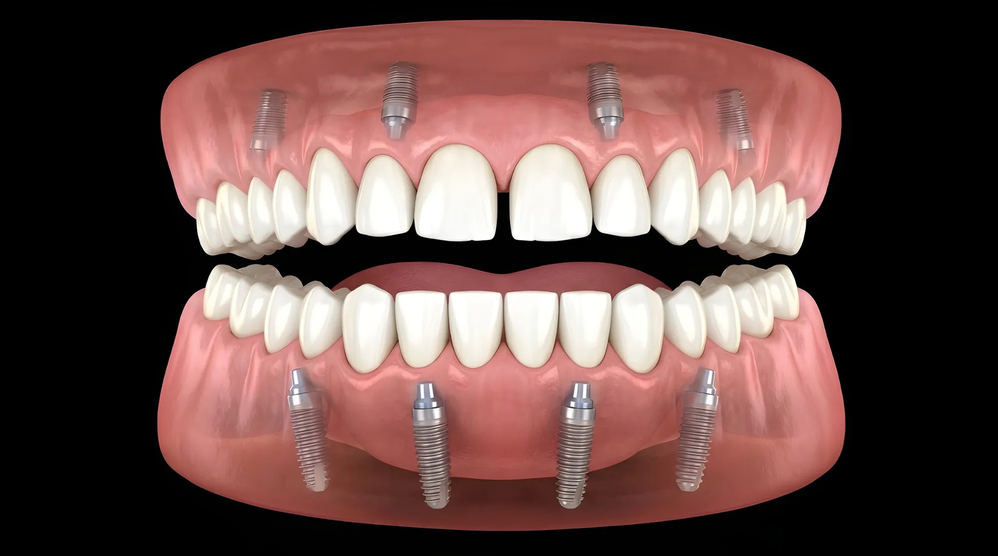 Full Mouth Implants