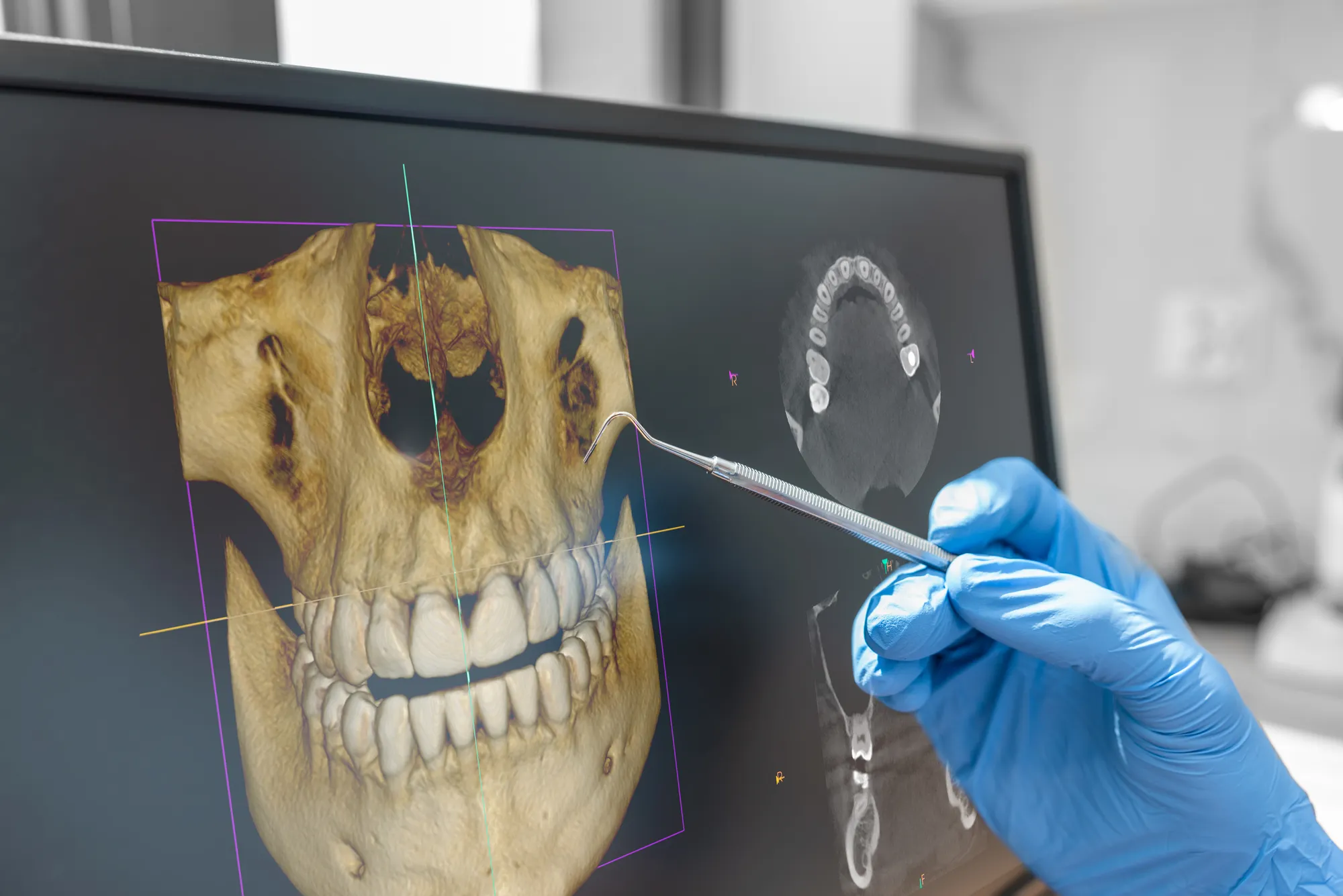 Guided Implant Surgery