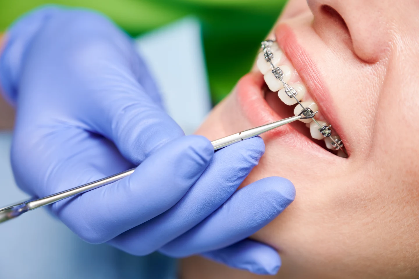 Braces in Newark, CA