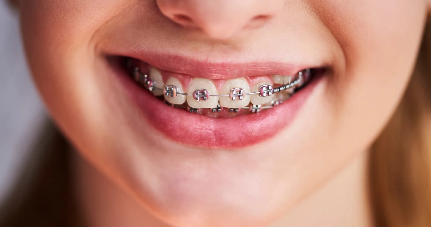 Orthodontics in Union City