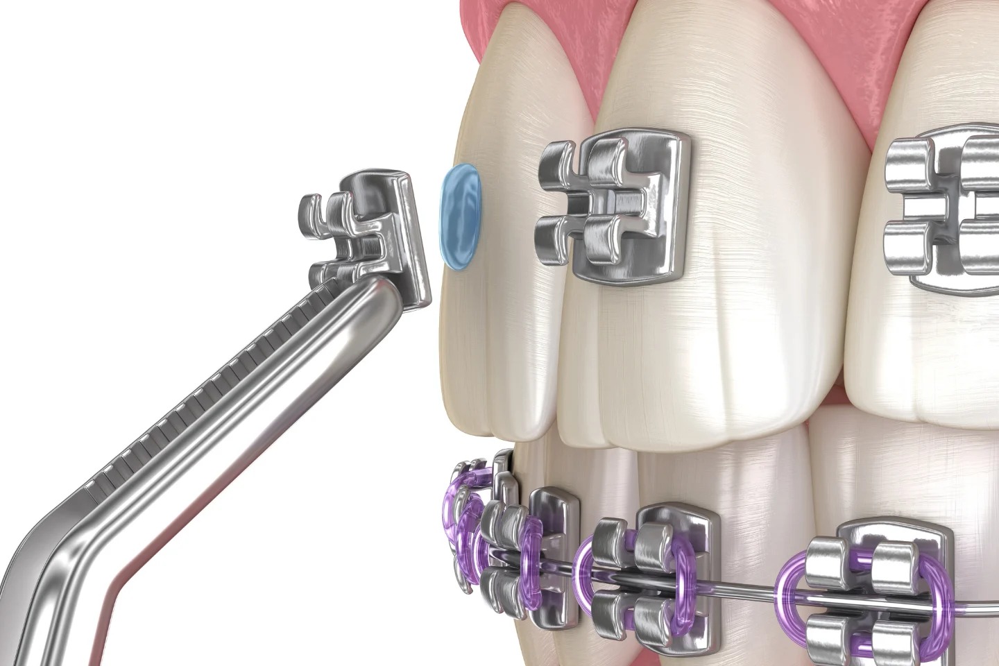 Orthodontics Near Pleasanton